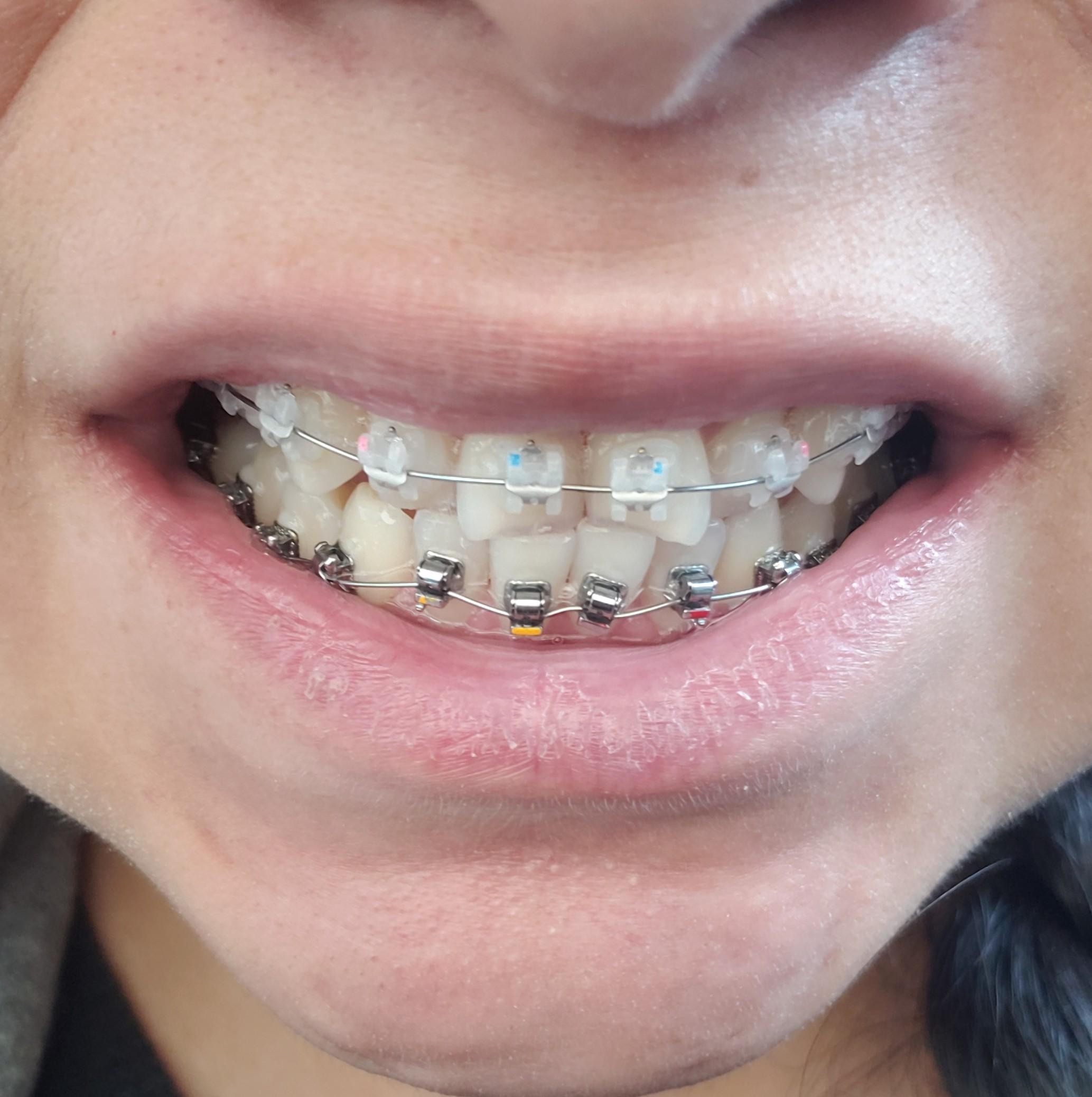 Braces At Day Scrolller