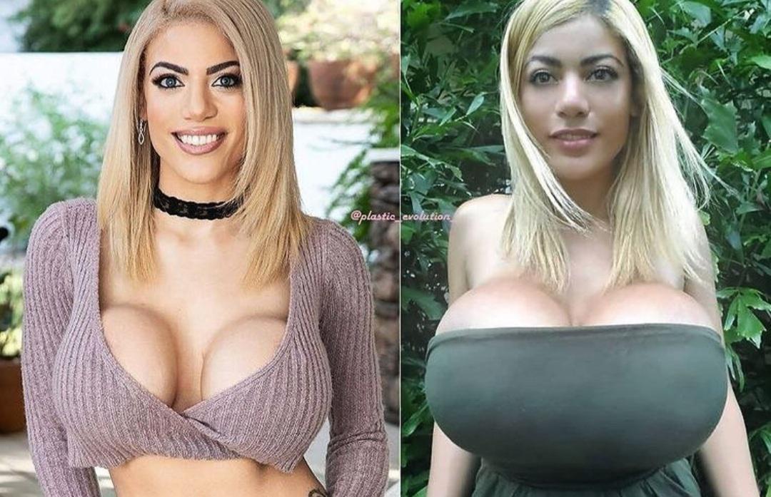 Amber Alena Before And After Hyper Inflation Scrolller