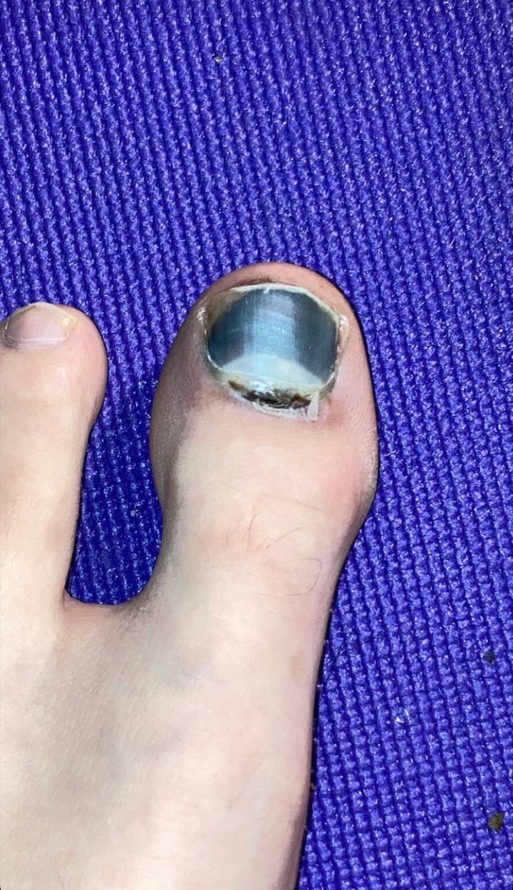 My Friends Toe Looks Like It S Got Frostbite After Dropping A Treadmill