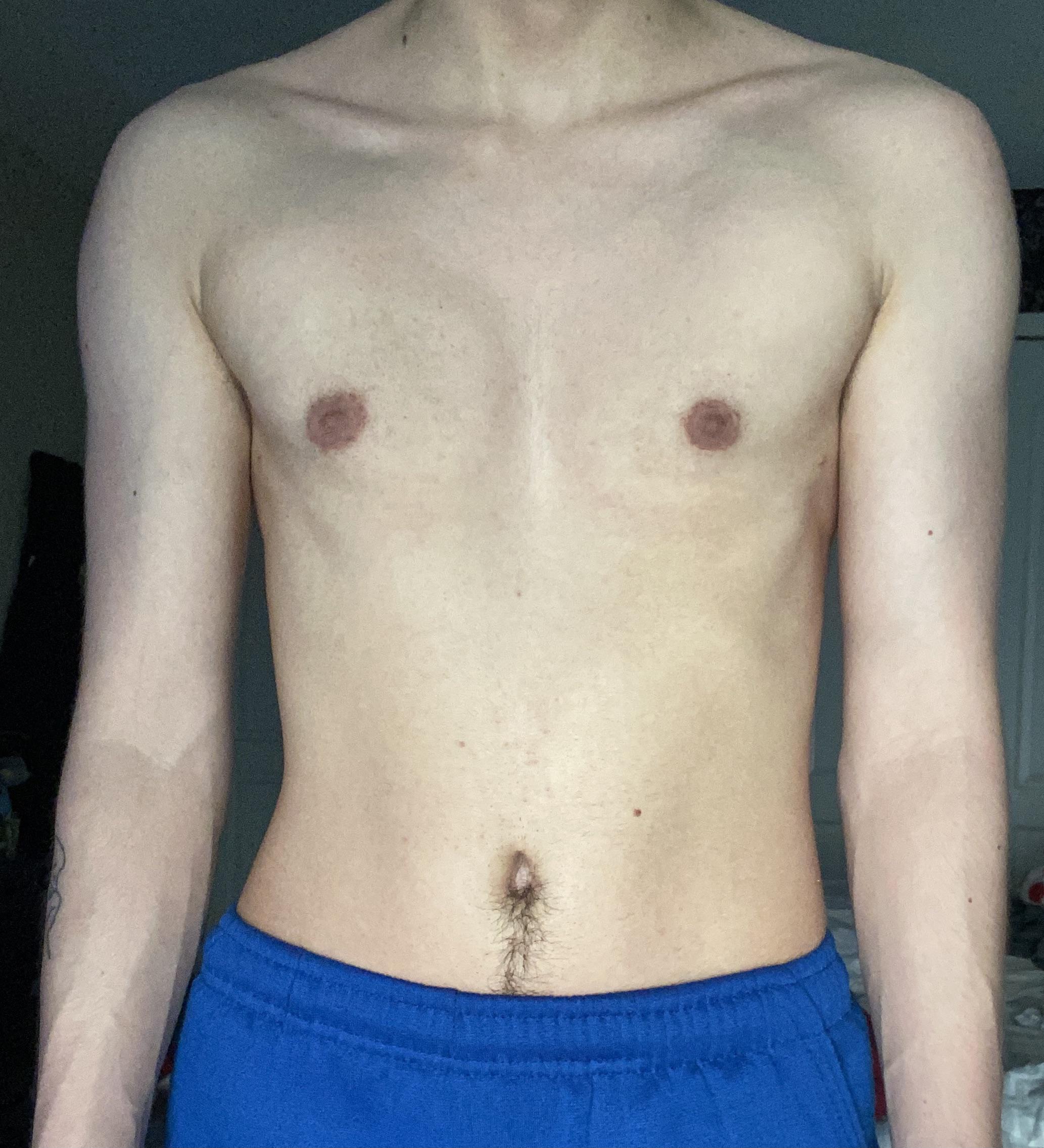 3 Months Post Op Peri Scrolller