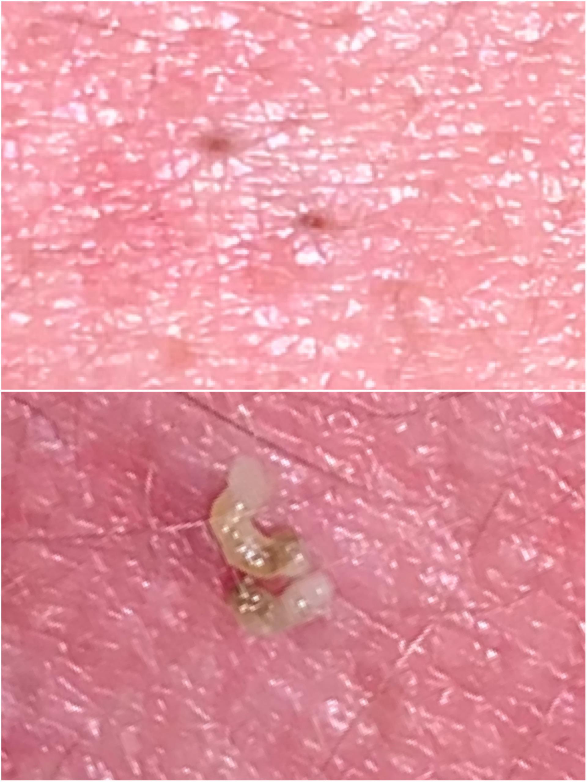 Astonishing Blackhead Removal: Before & After Photos - 469zlxa