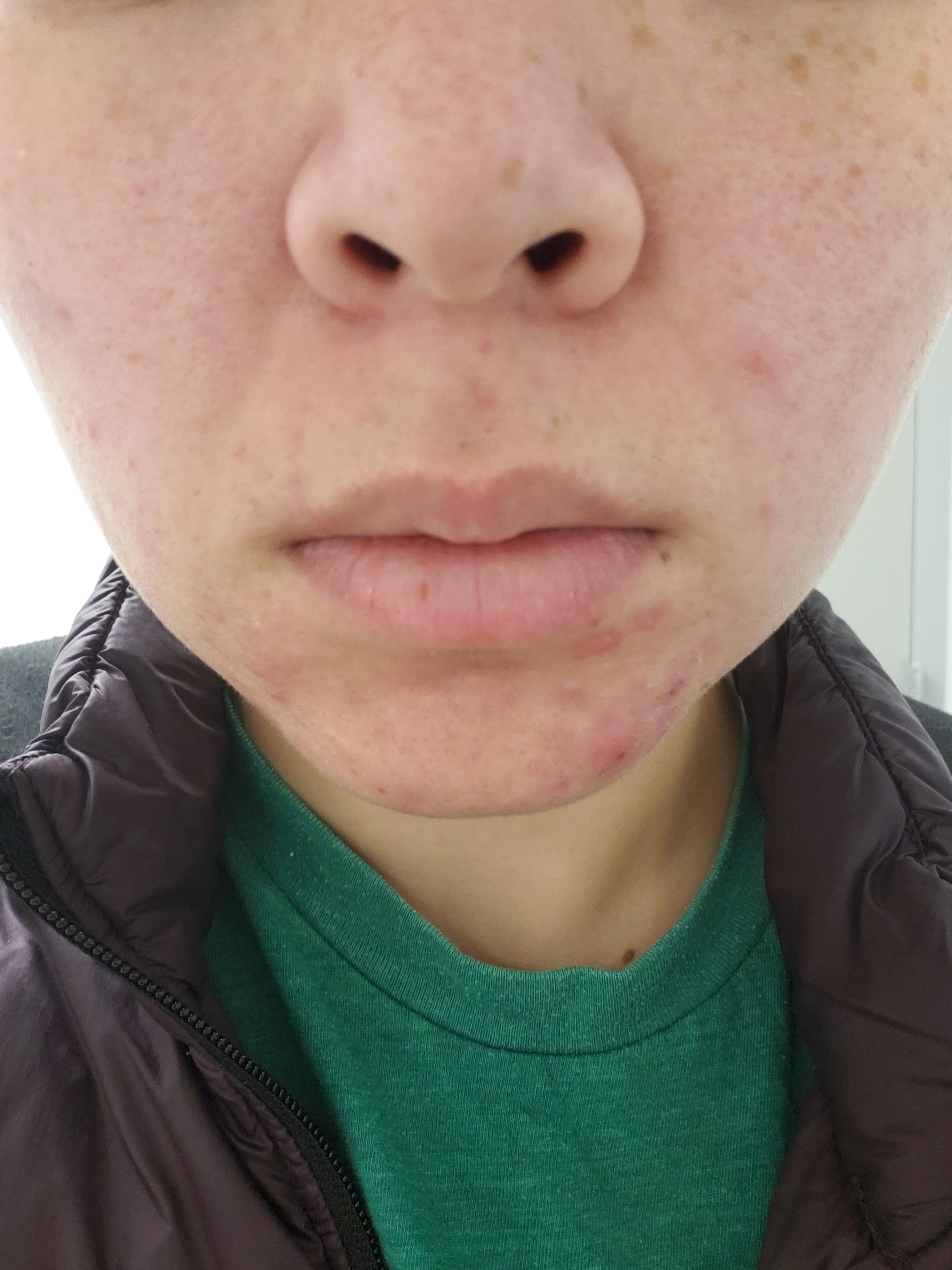 Face is always red and puffy? Why? What? Scrolller