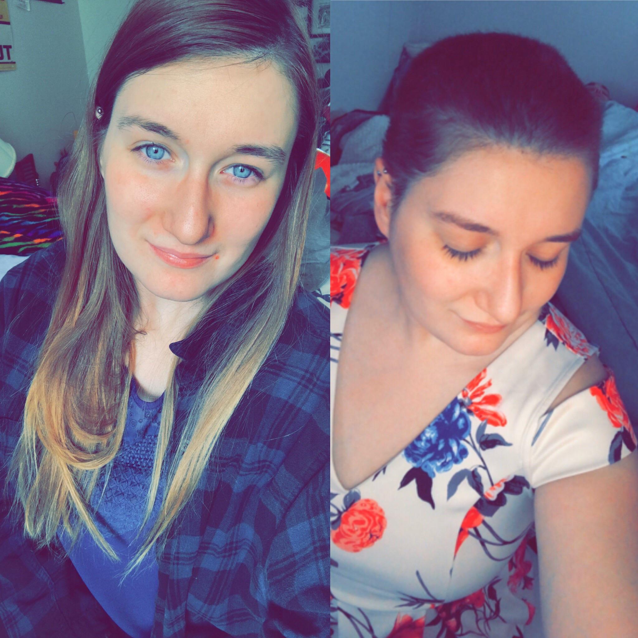 Hair was falling out from extreme stress and anxiety. Hubby shaved my head and I've never felt