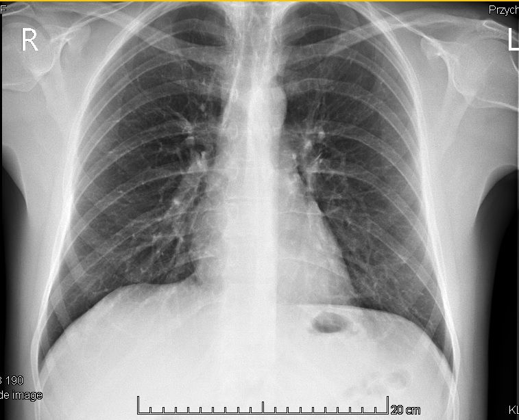 How healthy does my lungs looks like? | Scrolller