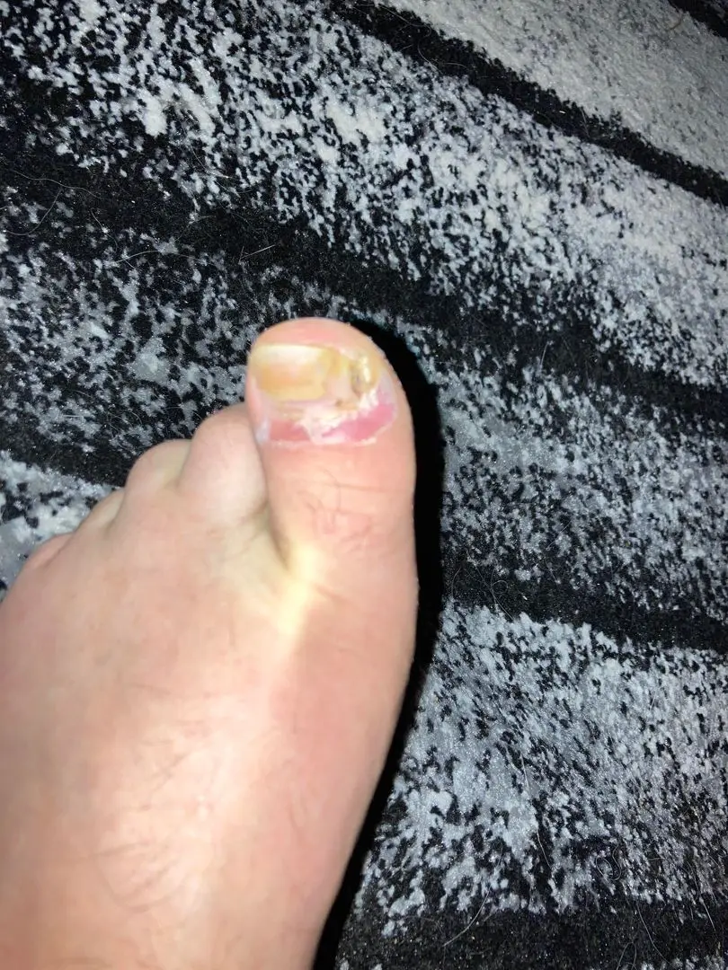 Infected toe with a damaged nail and red skin inflammation on a fair-skinned foot