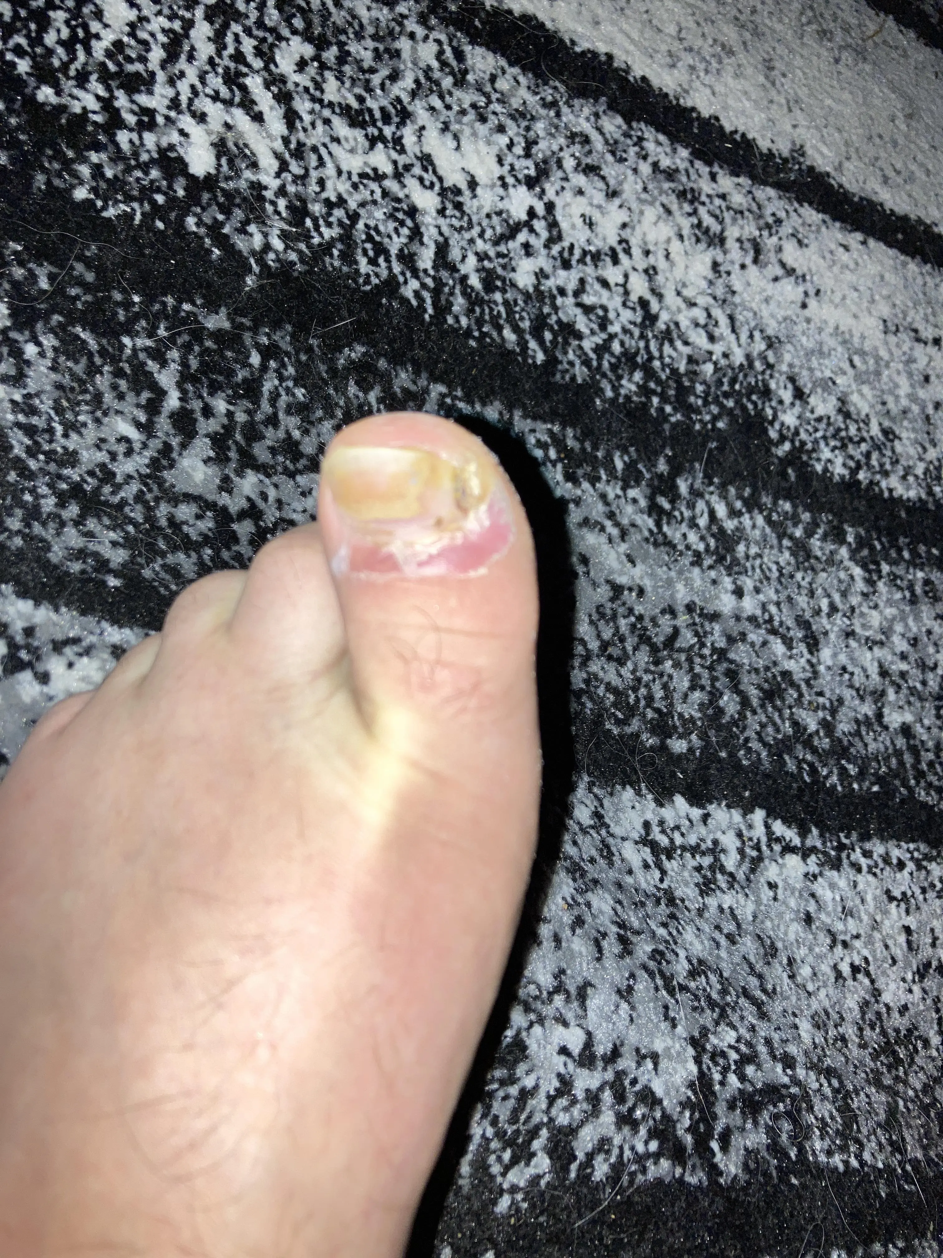Infected toe