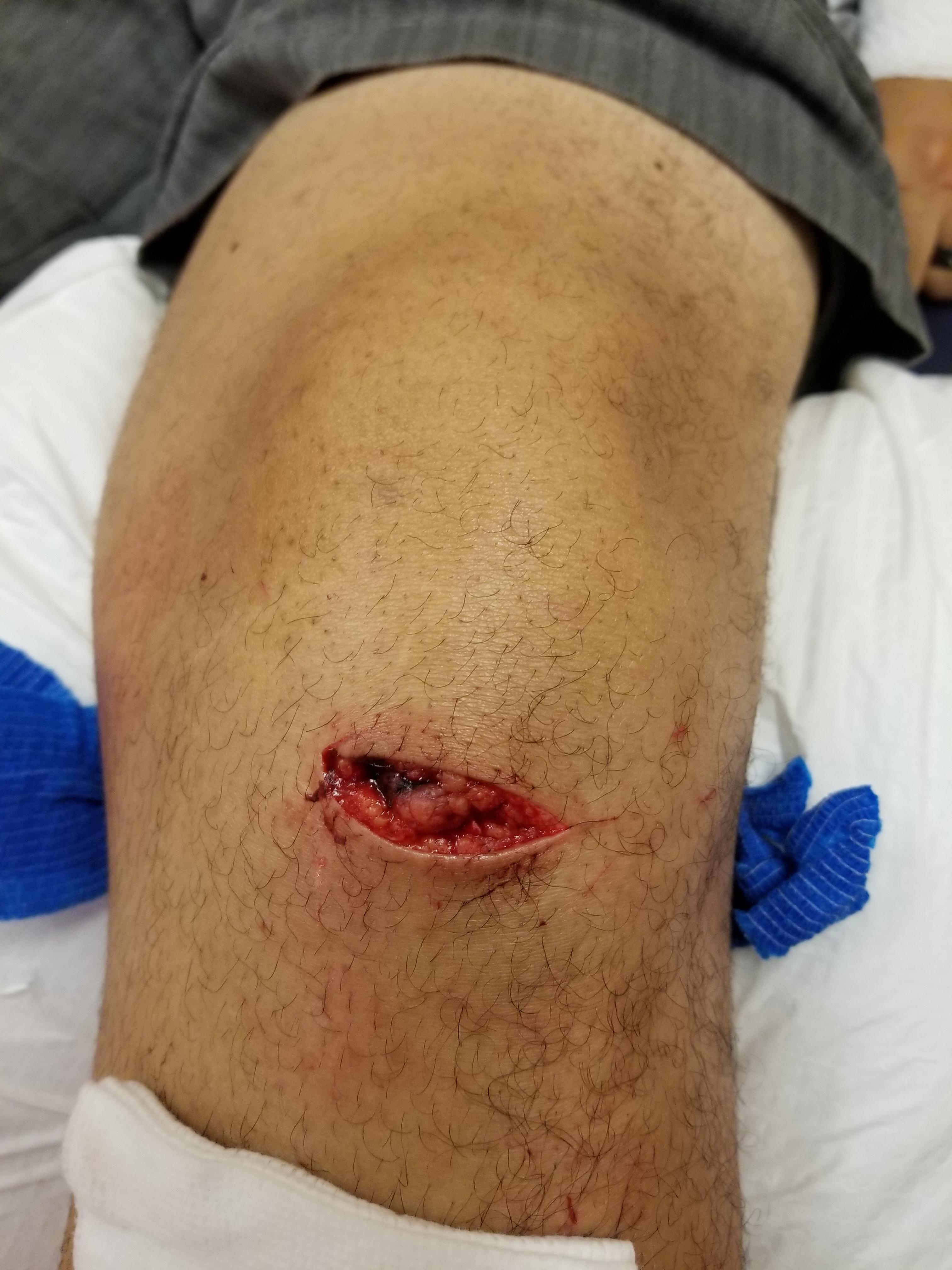 Laceration Causes Patellar Tendon Tear Scrolller