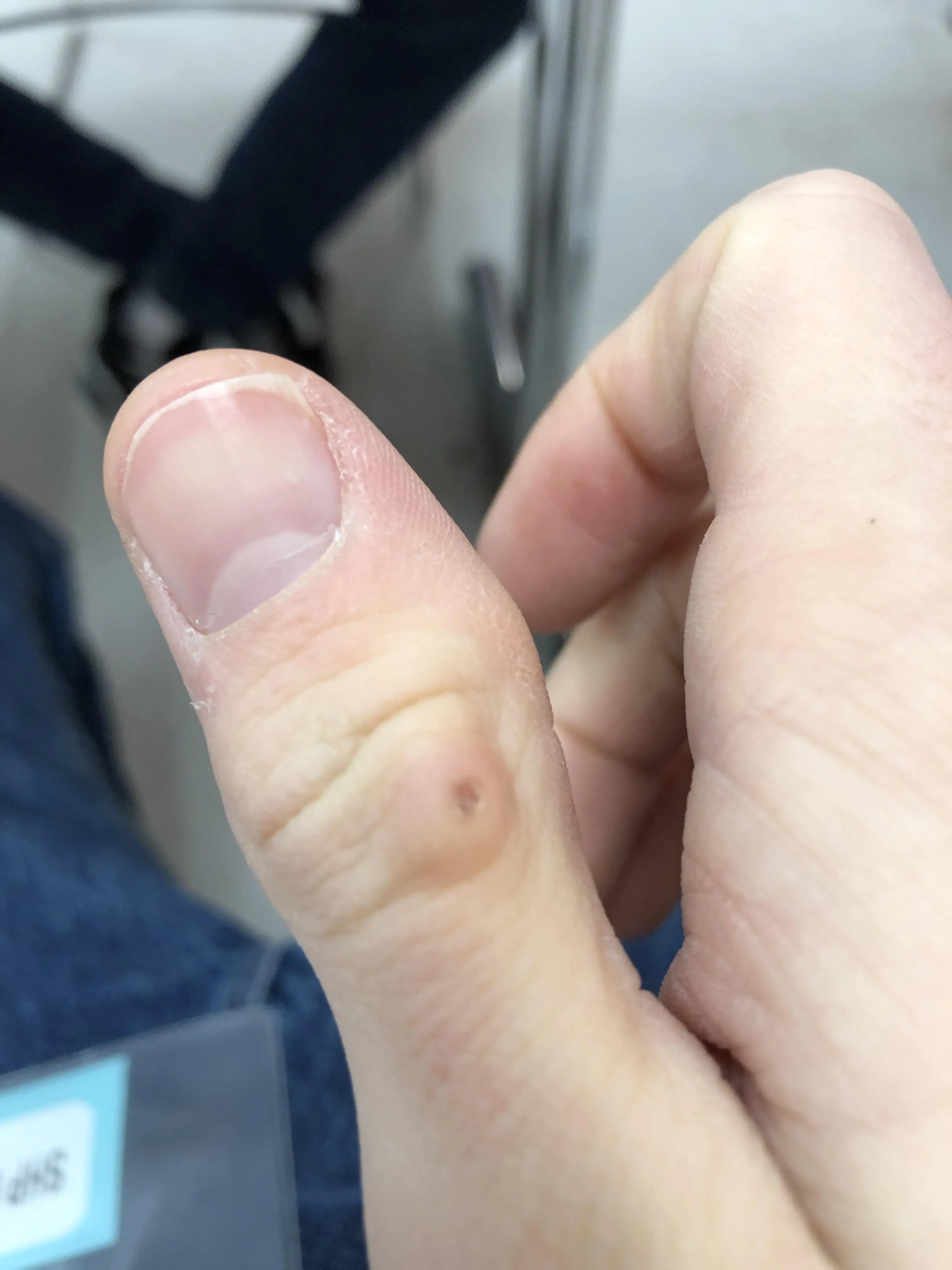 Lump on Thumb from Playing Clarinet. I have had this lump for about a ...