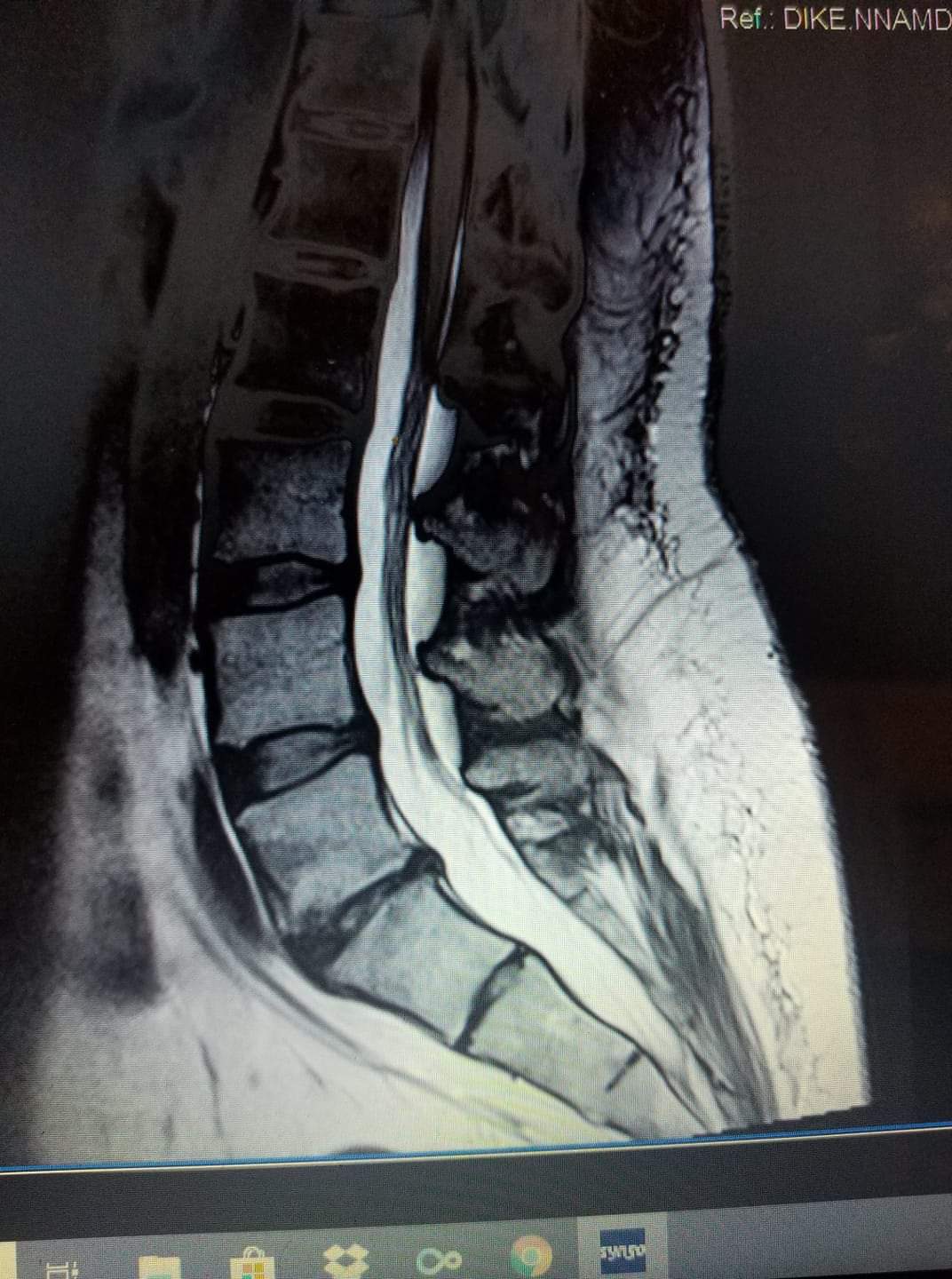 MRI of my back | Scrolller