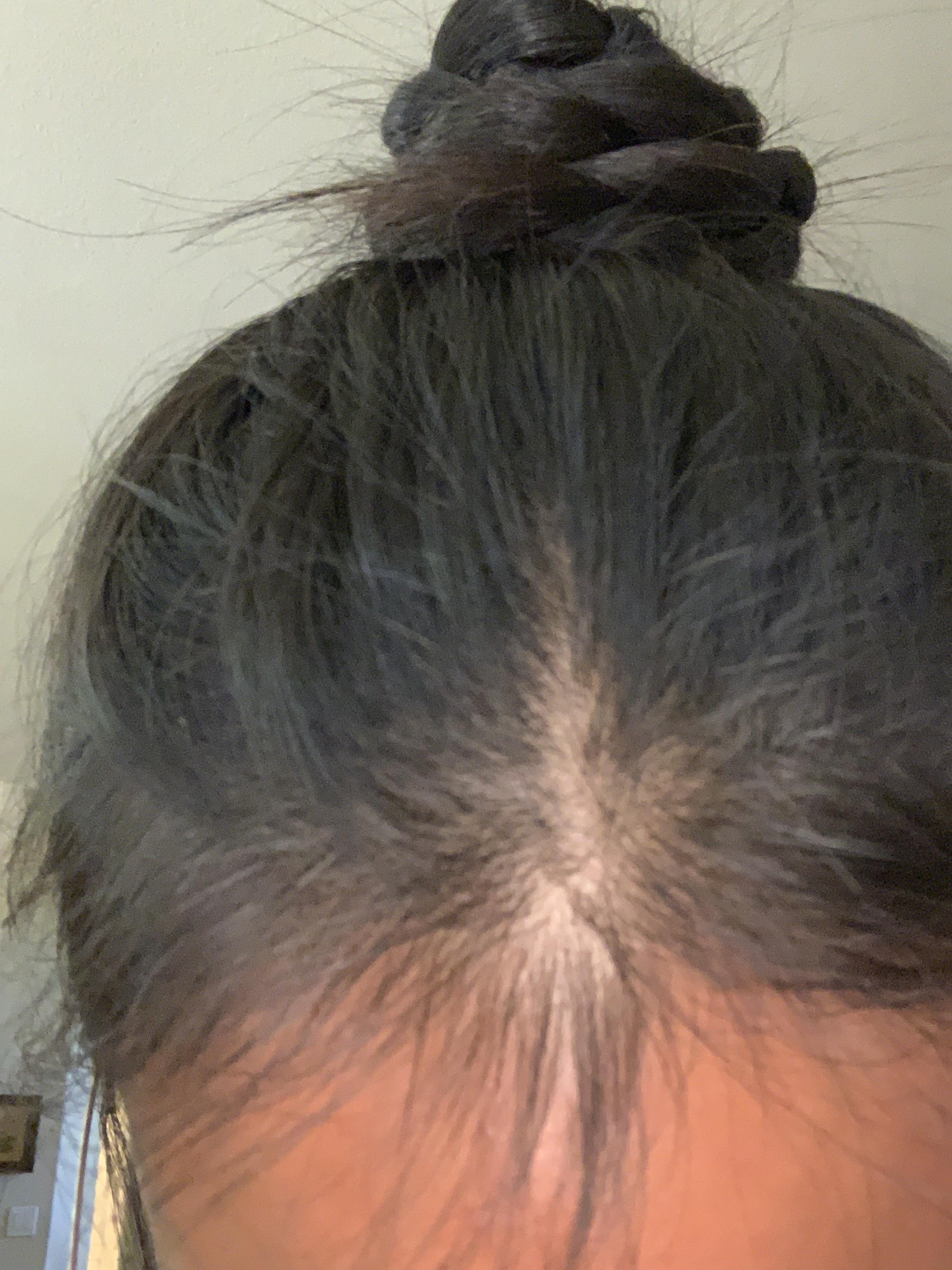 my-hair-is-thinning-everywhere-and-i-am-losing-hair-on-my-hairline