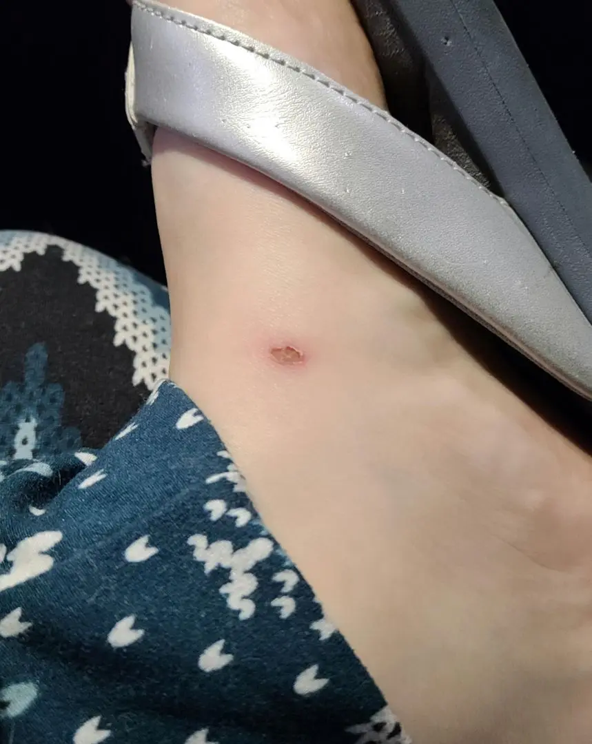 Close-up of a woman's foot in a silver heel with a red skin lesion from rubbing