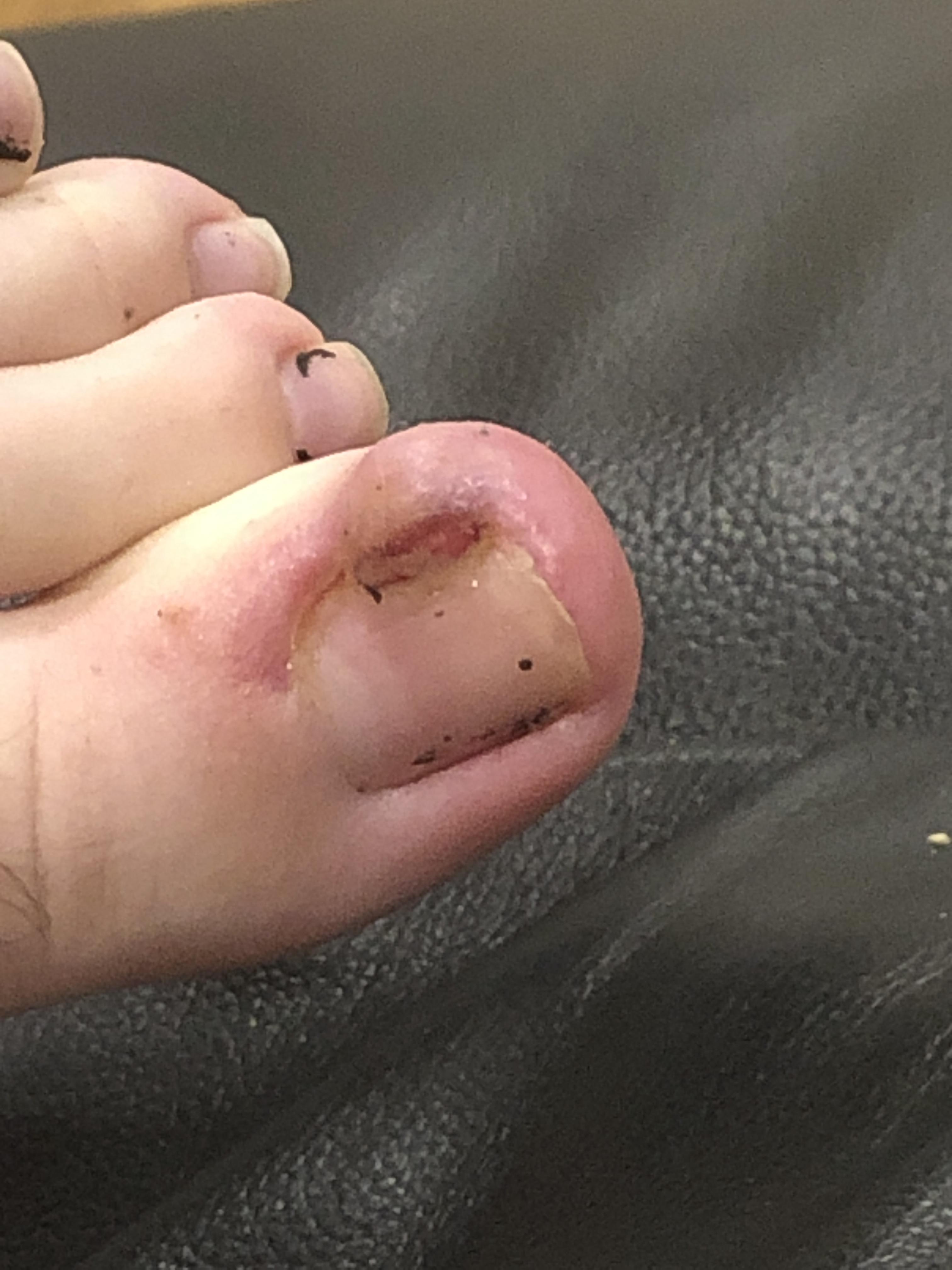 Infested Toe Not much but infected toe I have | Scrolller