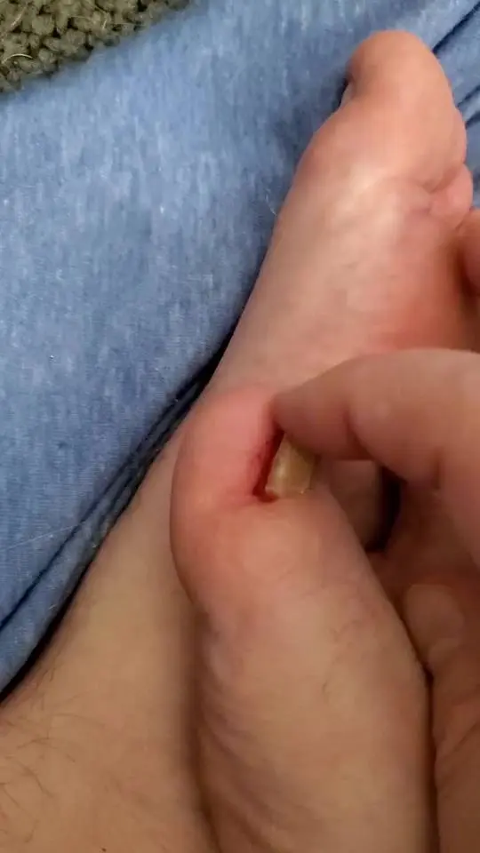 Pulling off a toenail | Scrolller