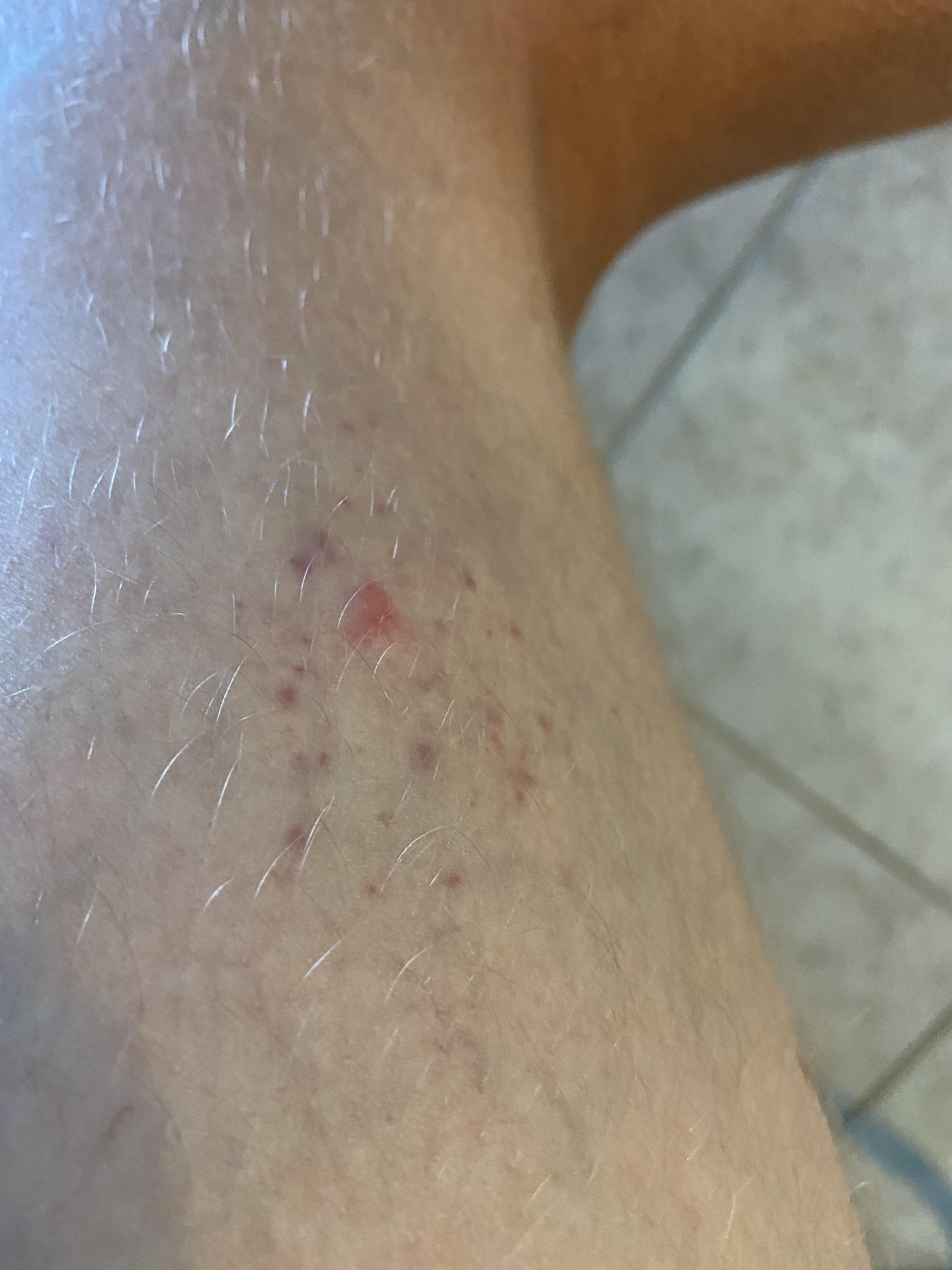 Purple spotted rash on thighs. | Scrolller