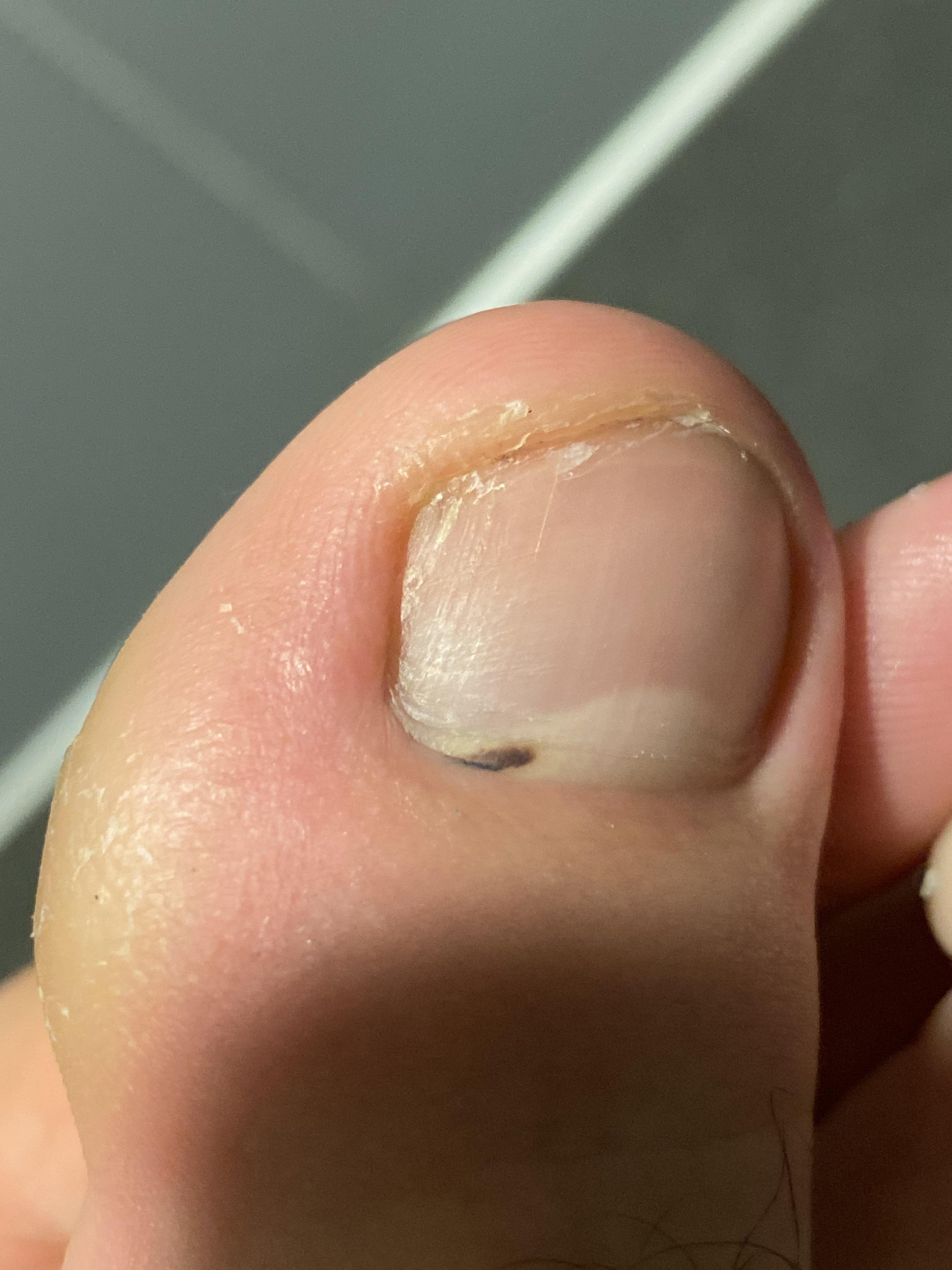 spot-under-nail-of-big-toe-should-i-be-worried-scrolller