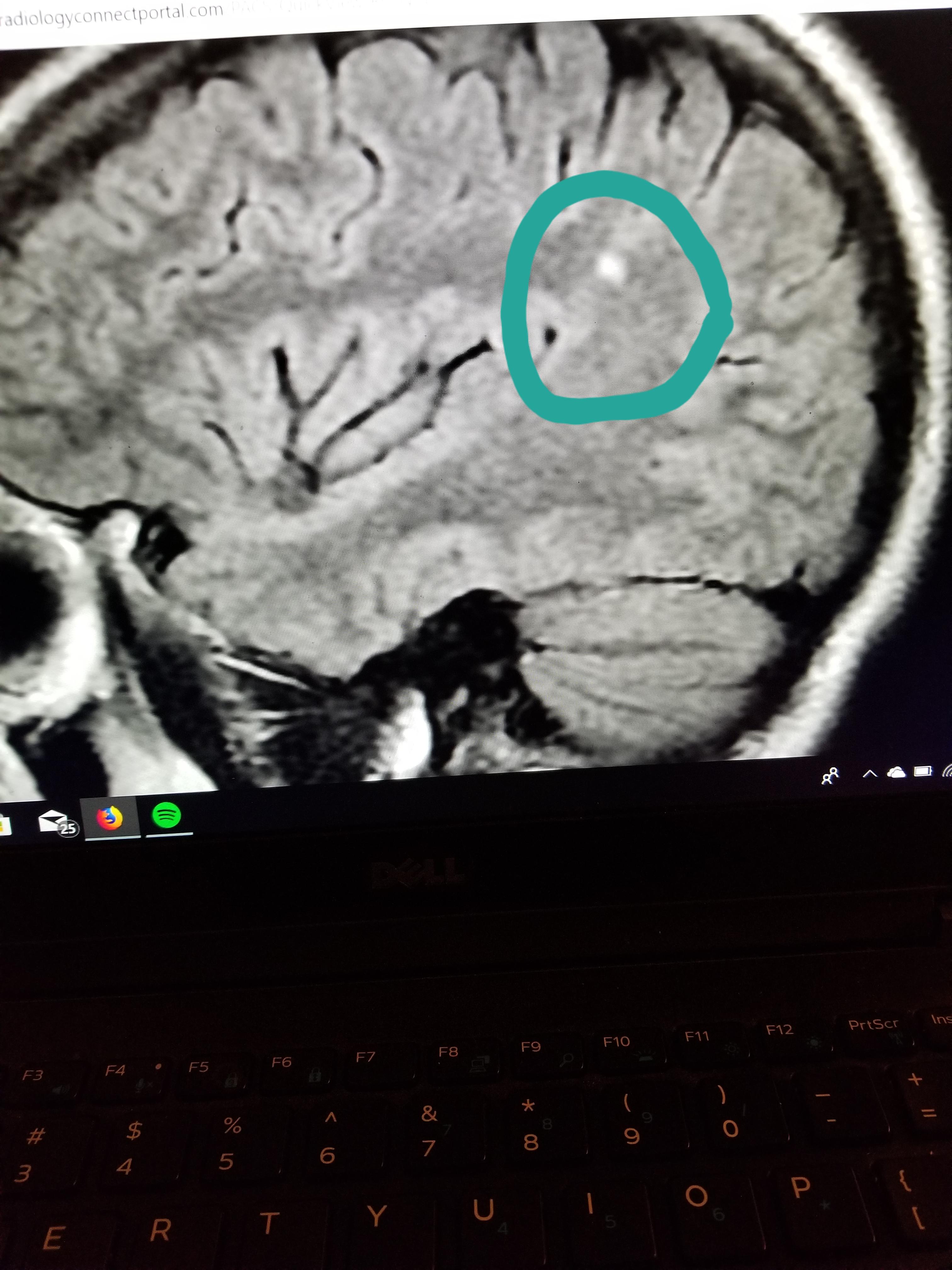 What Does A Dark Spot On Brain Mri Mean