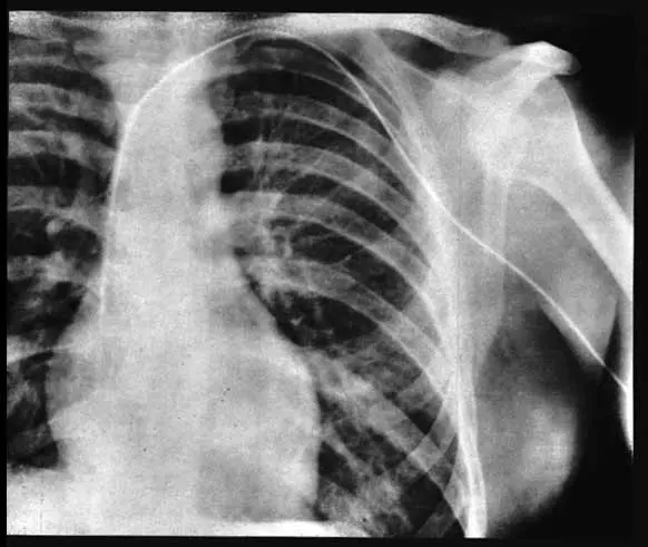 First Cardiac Cath X-ray verifying placement of the first cardiac catheter, which Werner ...