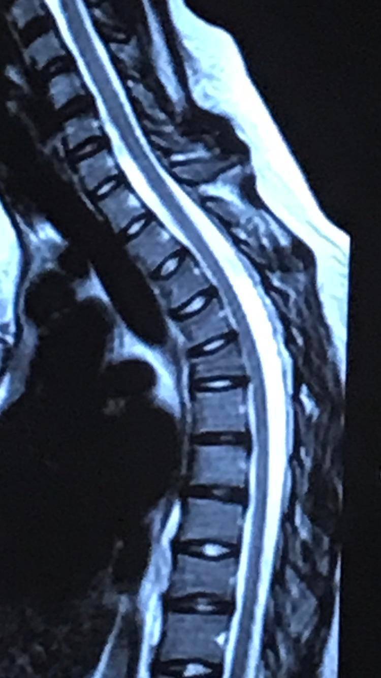 An MRI of my compression fractures in my thoracic spine Scrolller