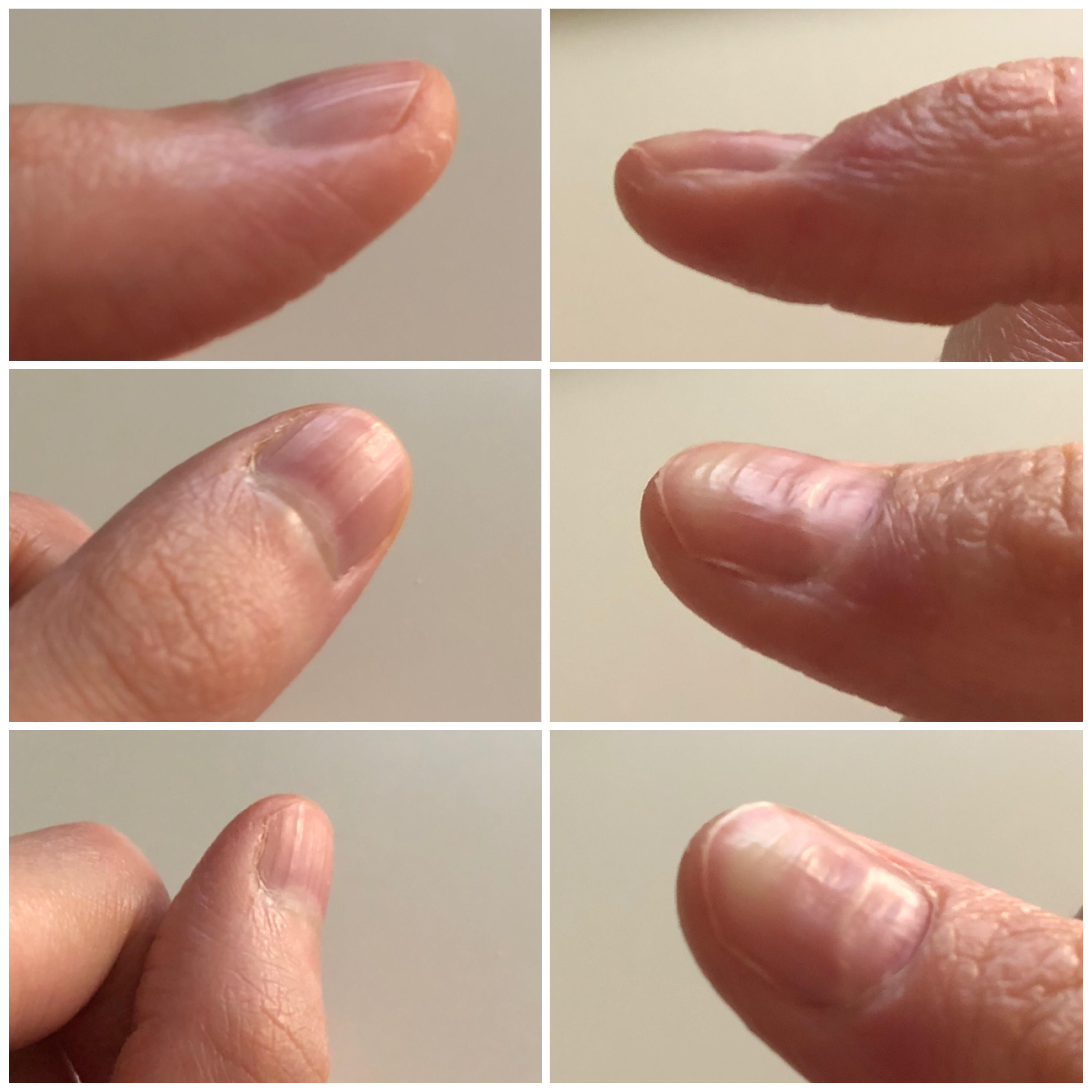 Beau’s lines on one thumb only? Comparison to my other thumb Scrolller