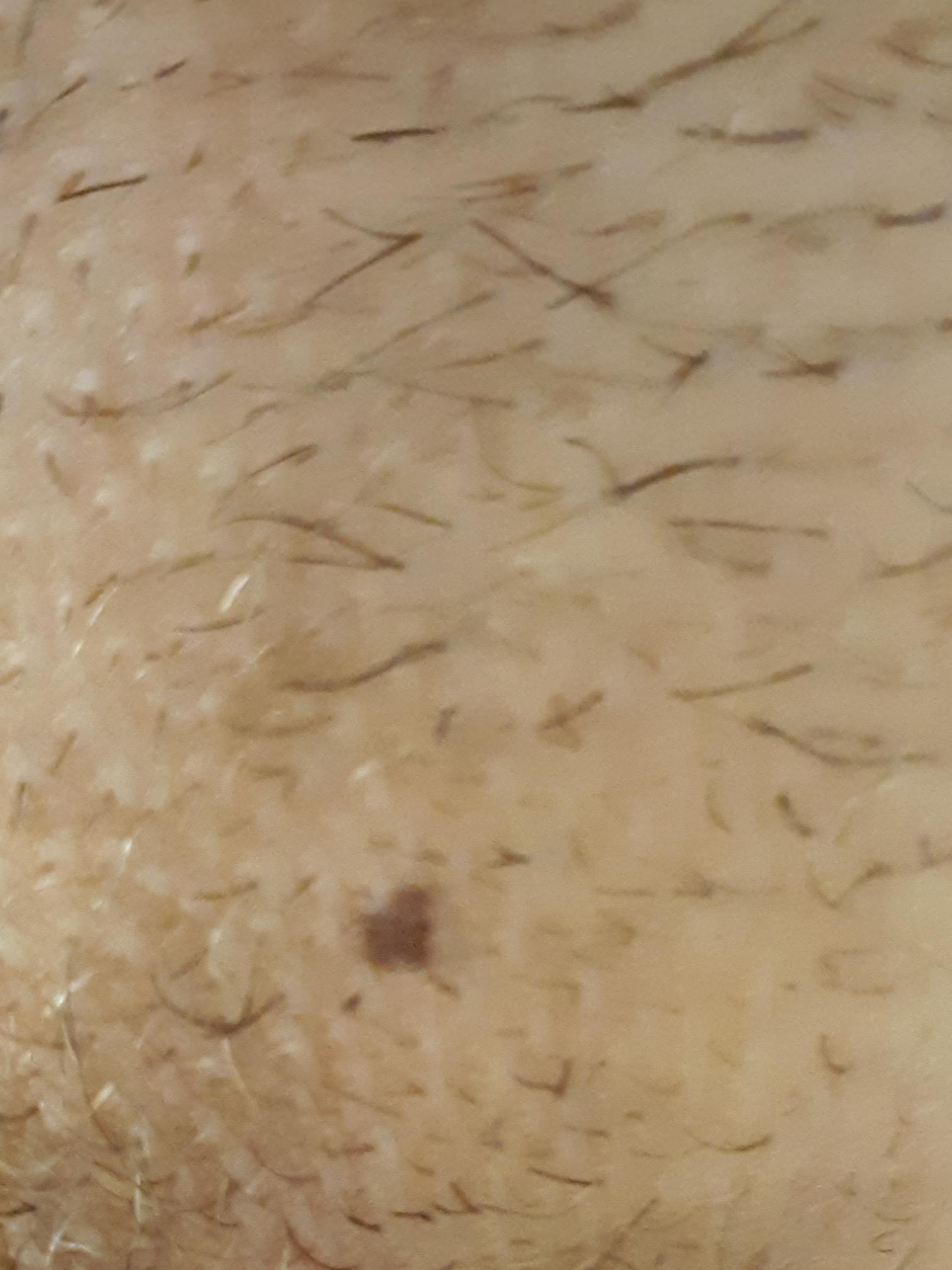 Does this appear to be a Melanoma? I am an 18 year old male and I have ...