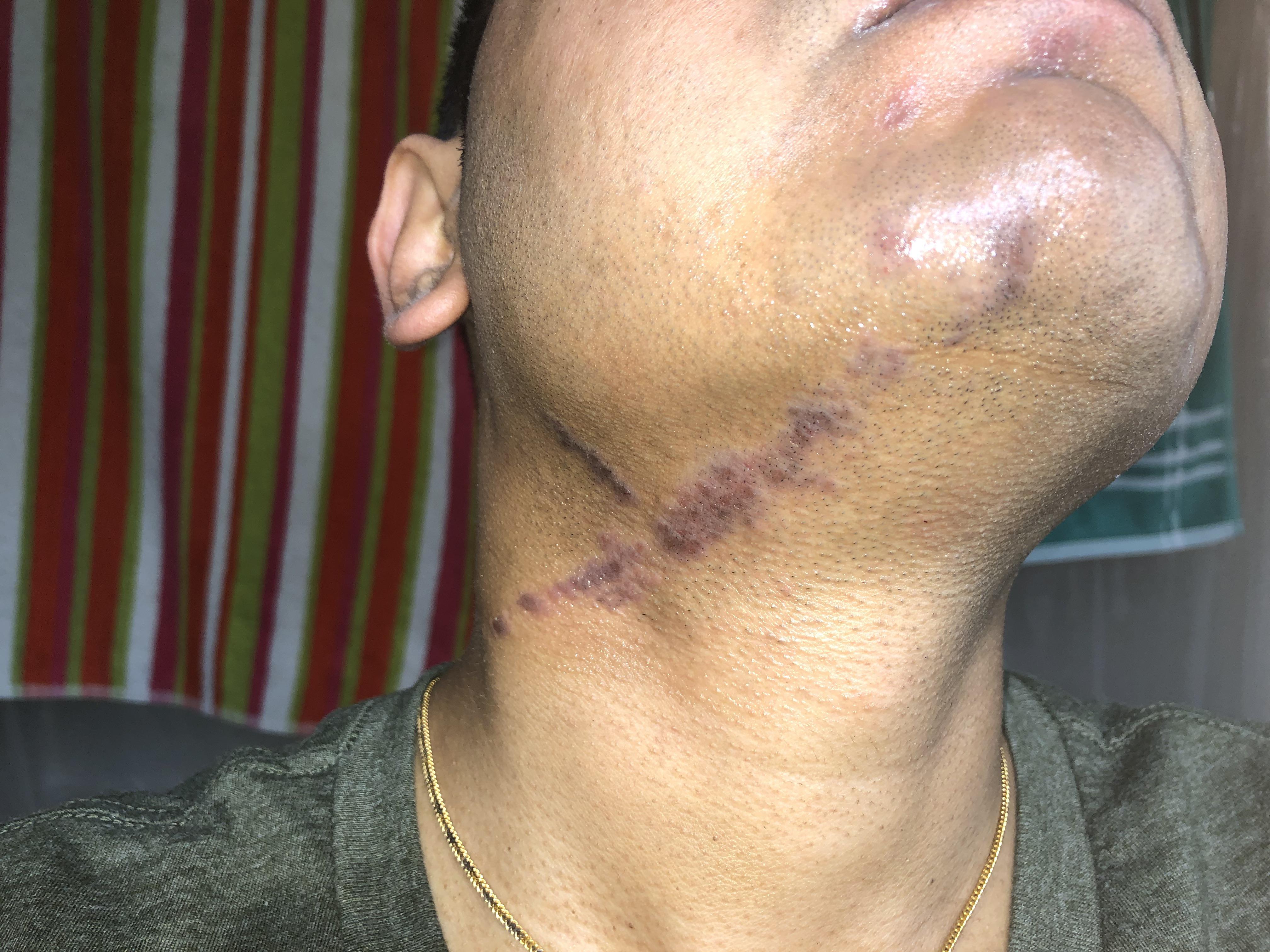 dry-and-dark-continuous-skin-patch-that-starts-at-throat-area-and