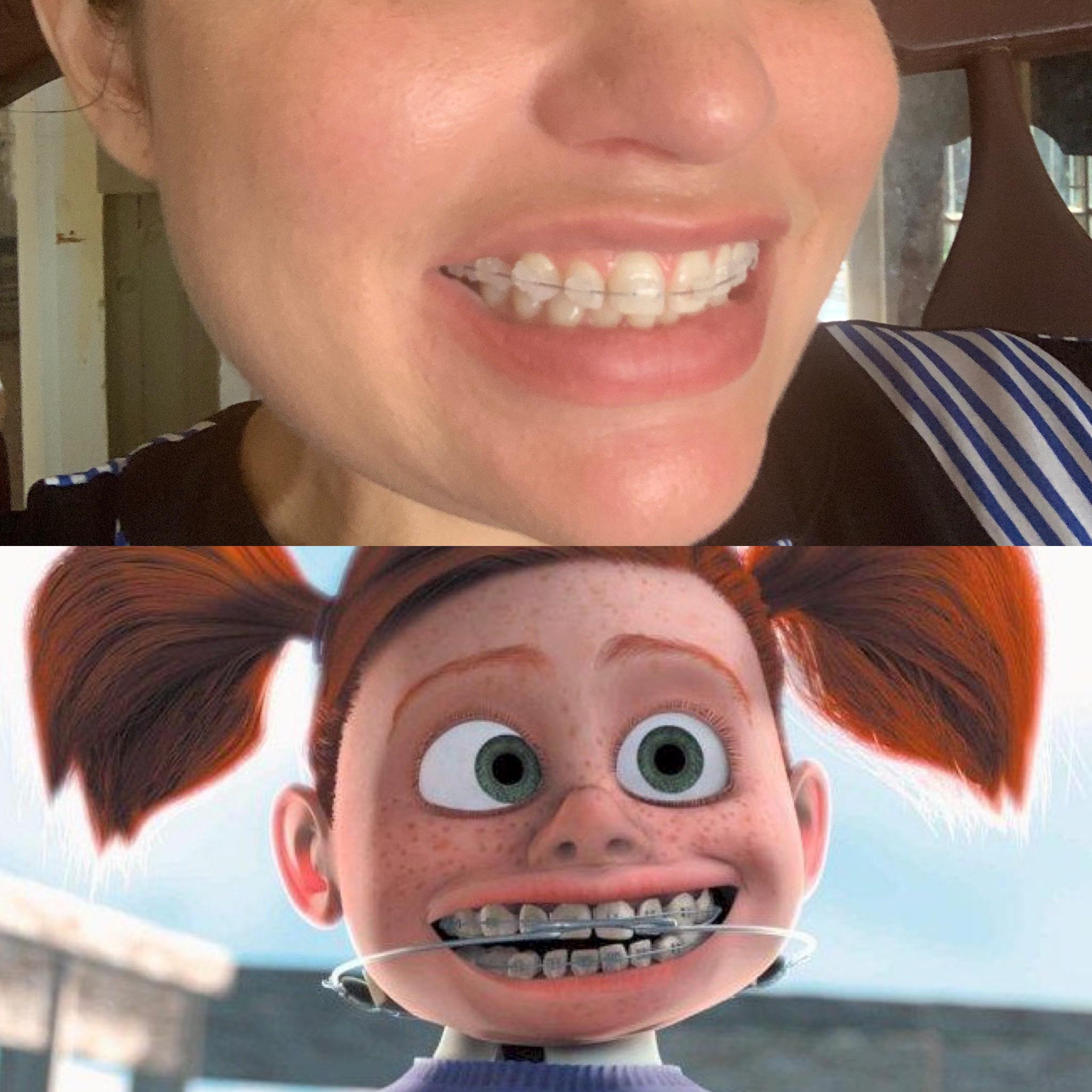 First day of braces. Wanted this for so long. | Scrolller