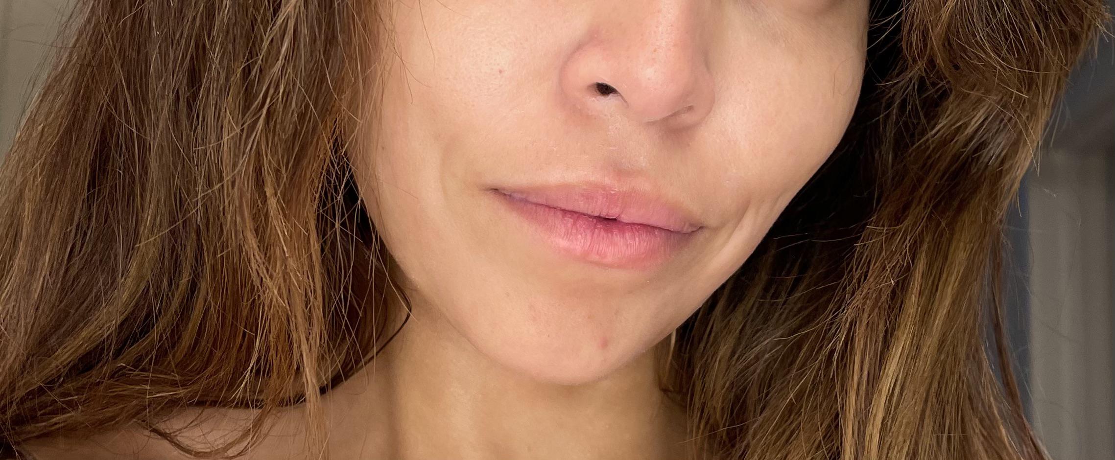 How to fix lines around my mouth when I smile closed lip? Can Botox