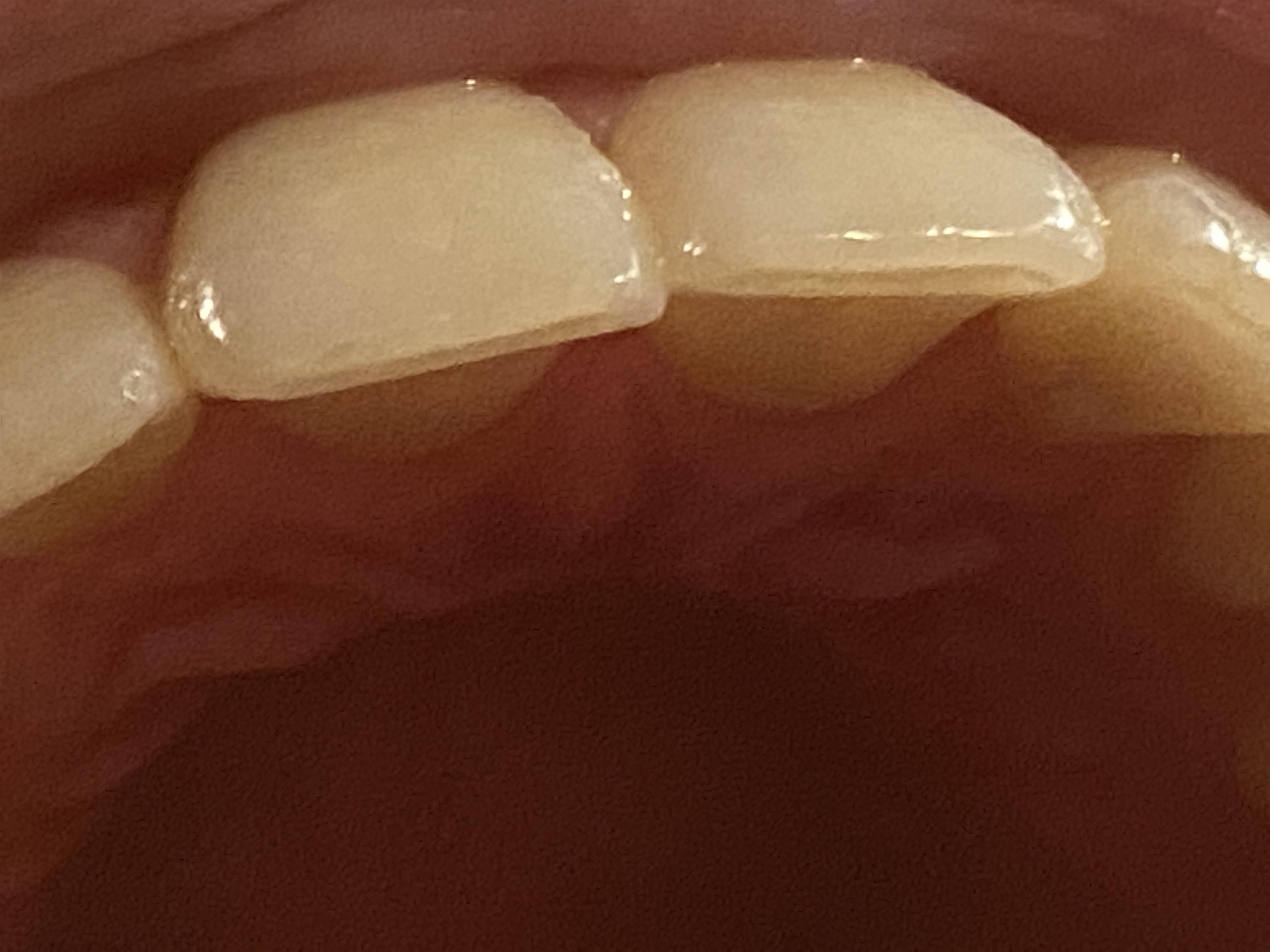 I got my braces off four years ago and they drilled the ridges out of ...