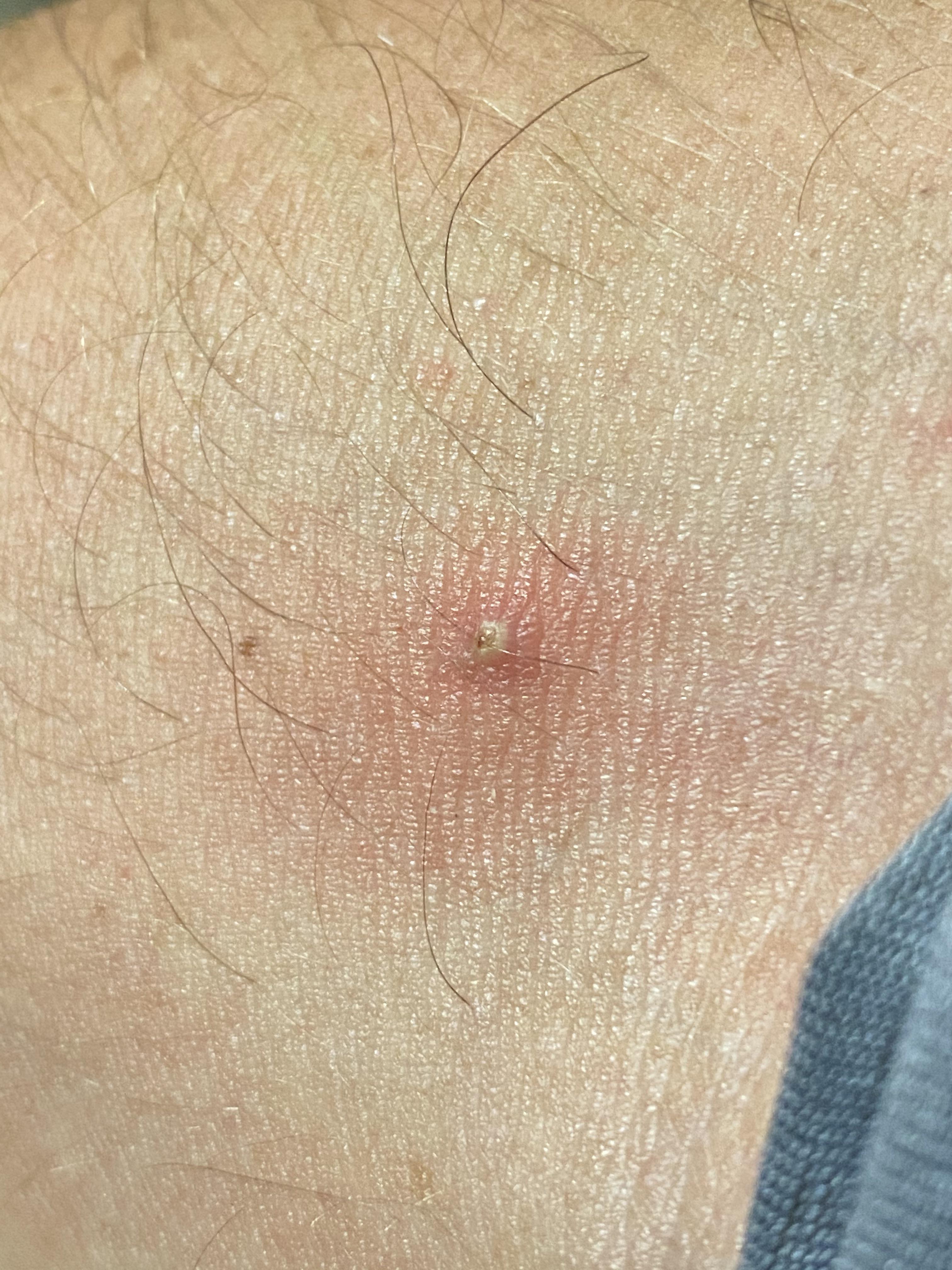 Infection from injection?! Keep just getting more visual and starting ...