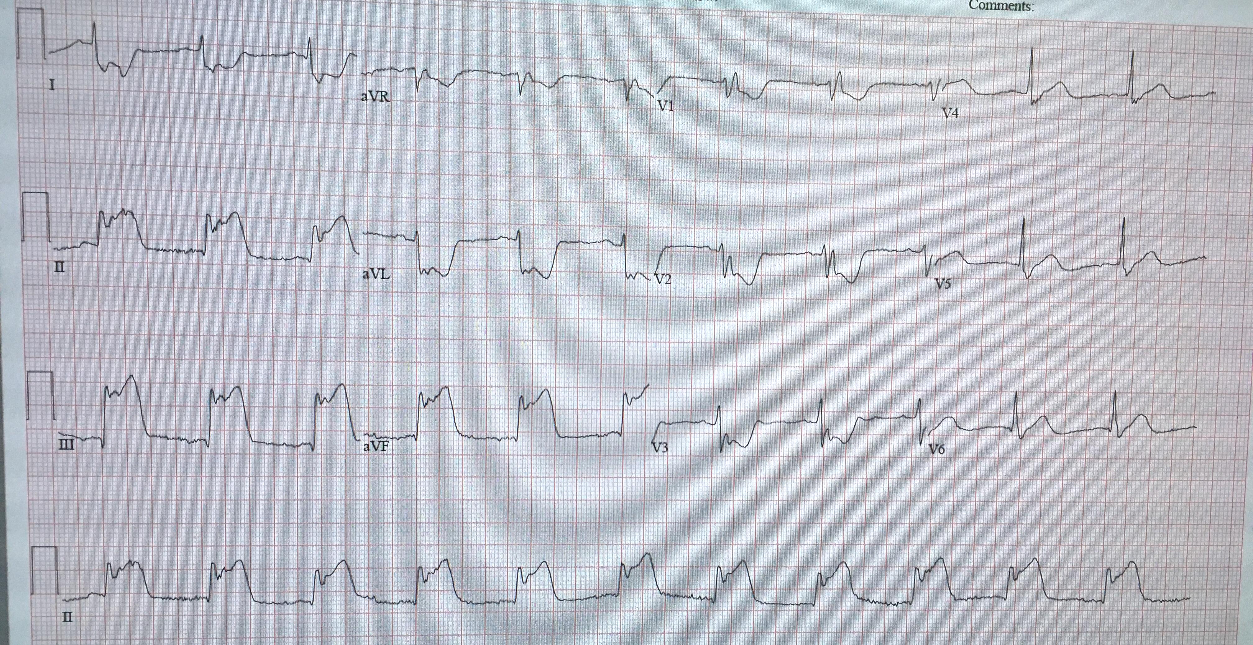 insane STEMI in the ED last night | Scrolller