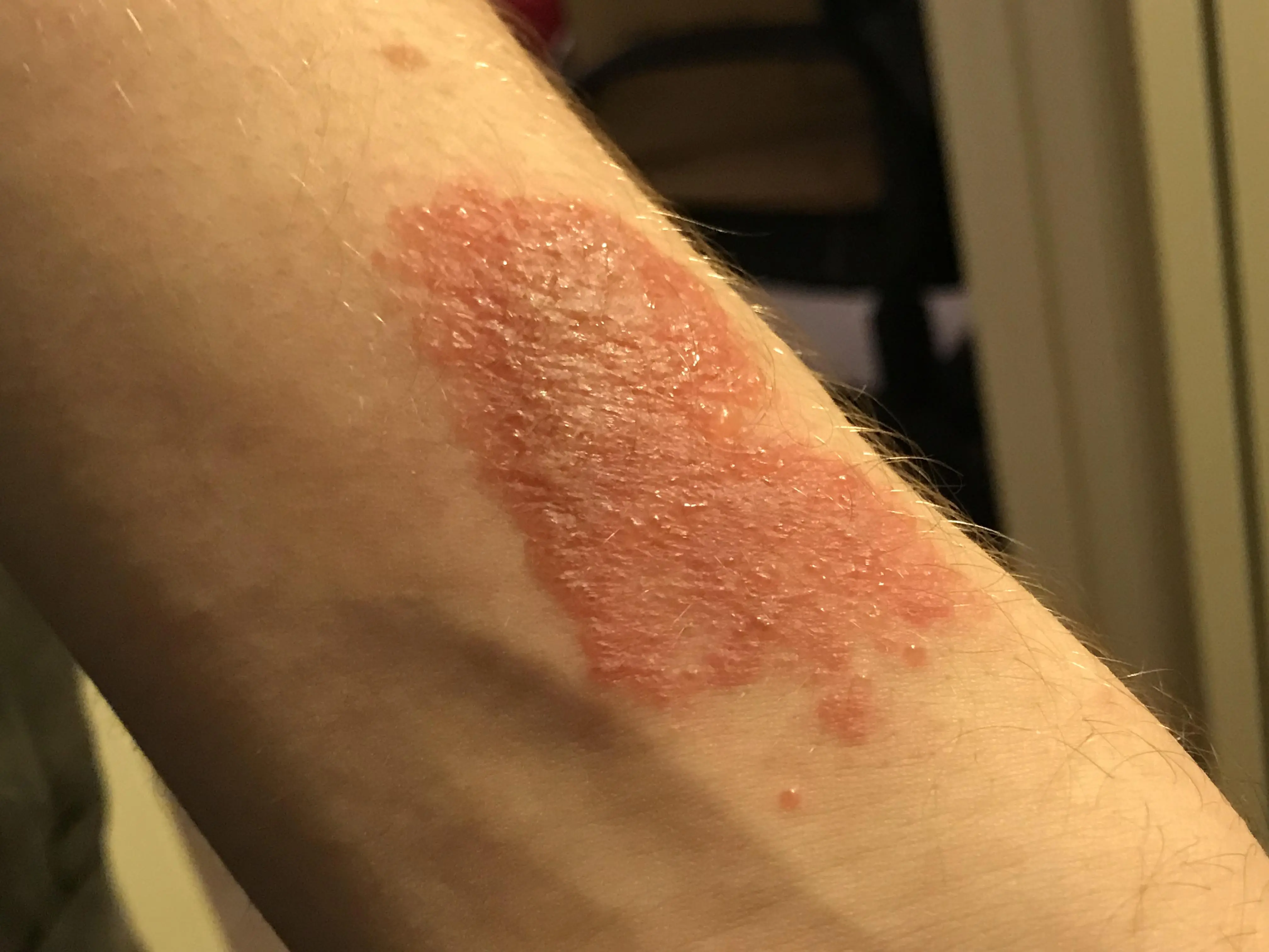 Left Forearm Rash My friend acquired a rash on his left forearm close to the wrist about ...