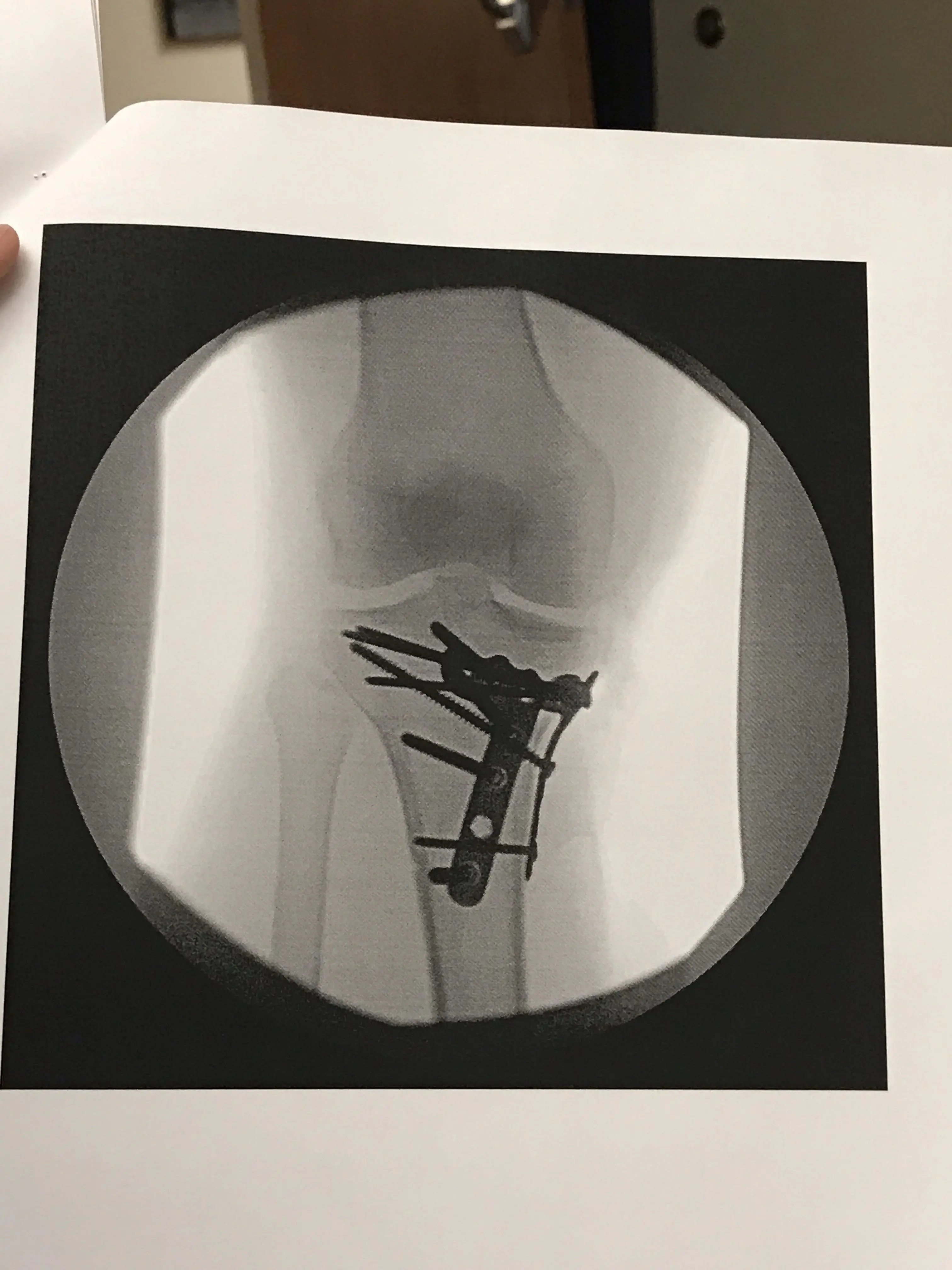 Tibia Hit My sedan got hit by a truck; type 4 Tibial Plateau fracture | Scrolller