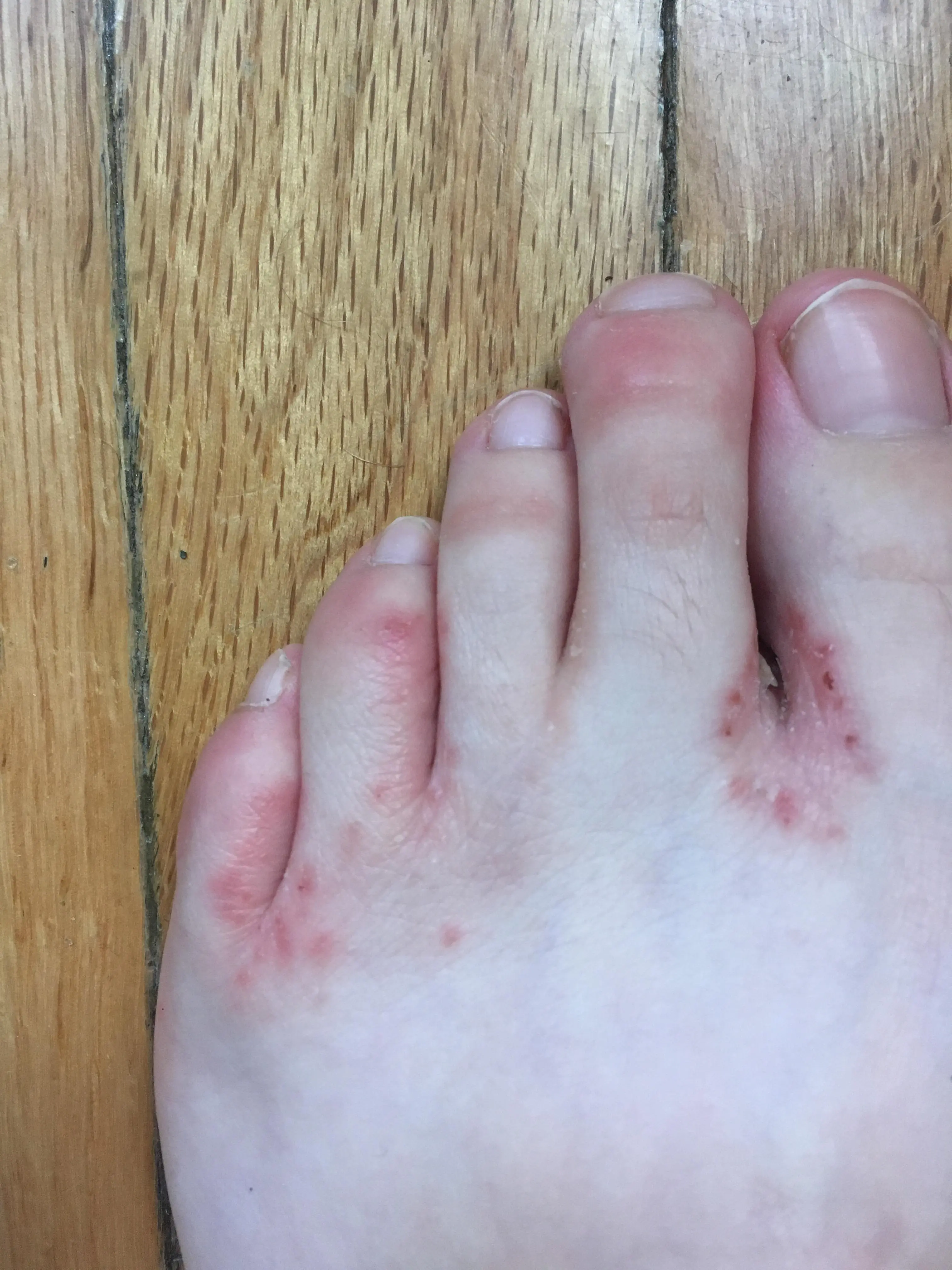 Painful itchy rash! Help! I’ve tried hydrocortisone and lamisil to no ...