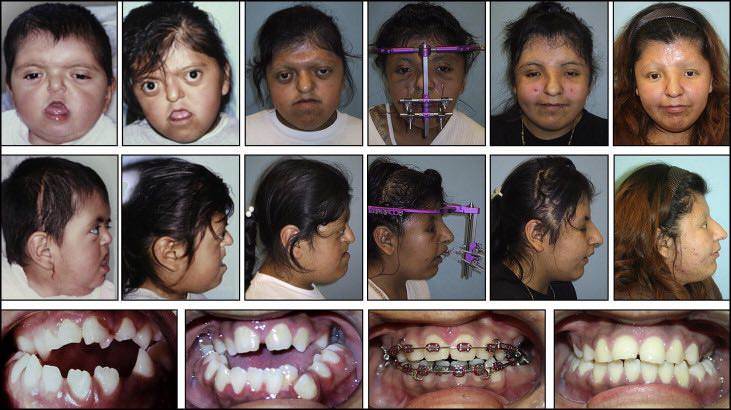 Patient With Apert Syndrome Facial Morphology And Occlusal Changes In