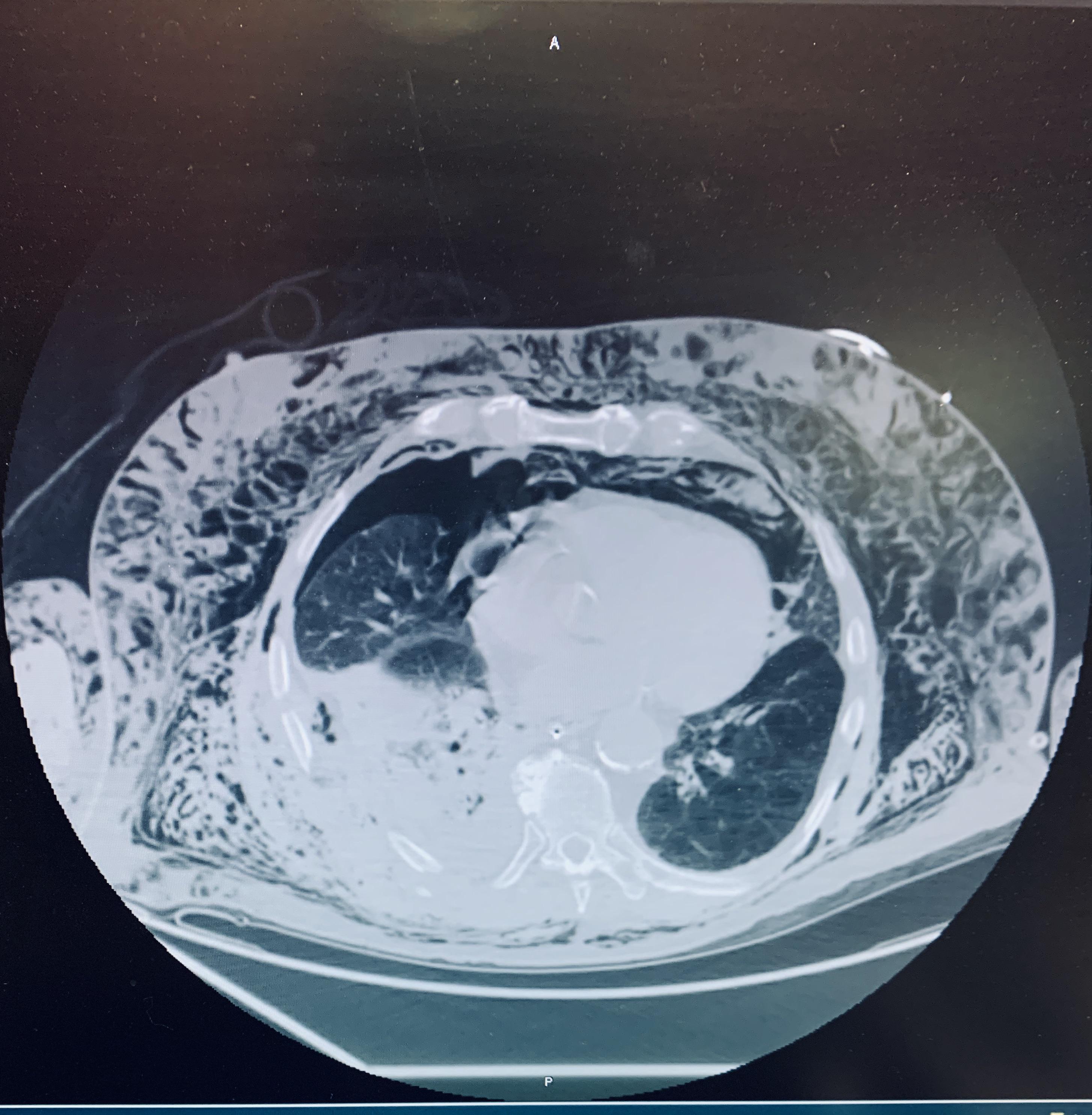 Subcutaneous emphysema due to multiple rib fractures Scrolller