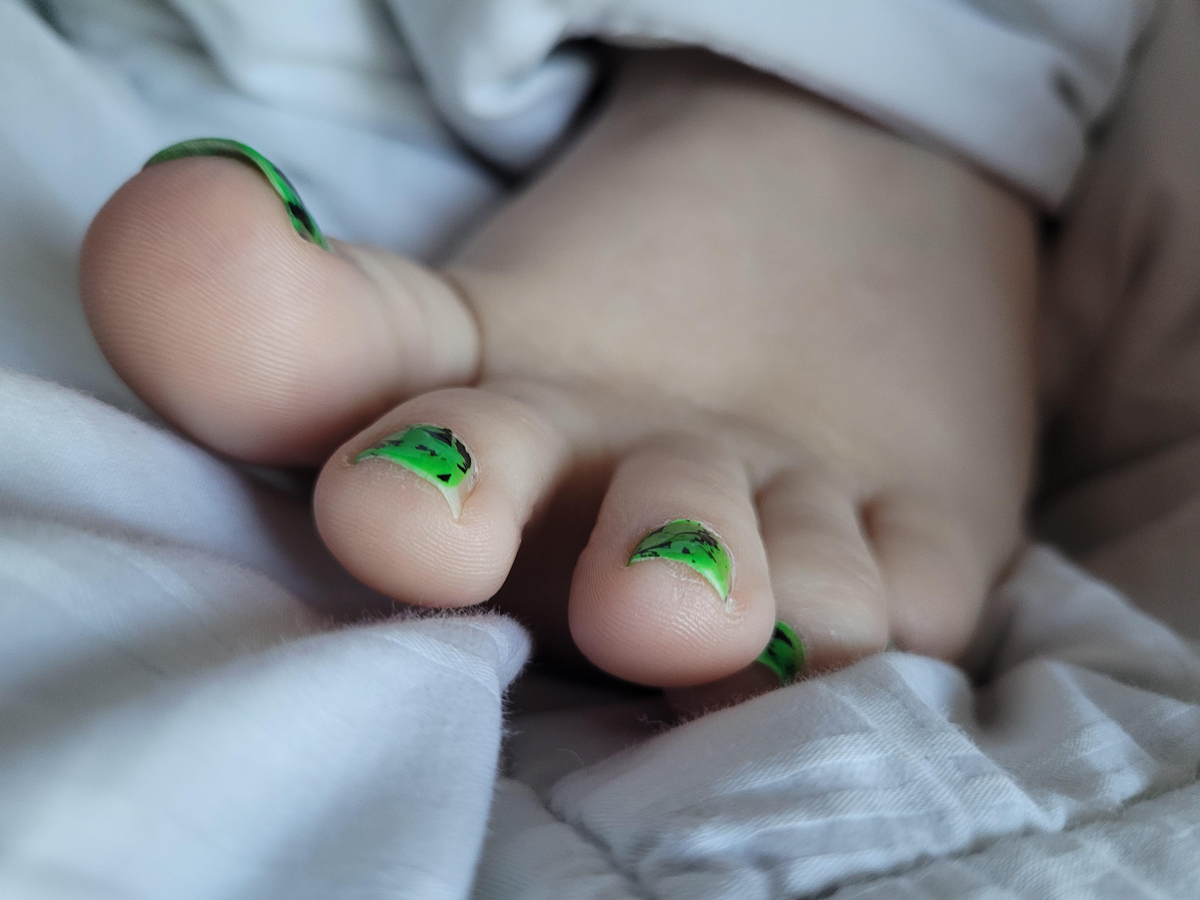 Never Ignore This: Swollen Toes & The Shocking Tumor Diagnosis - c77hmry