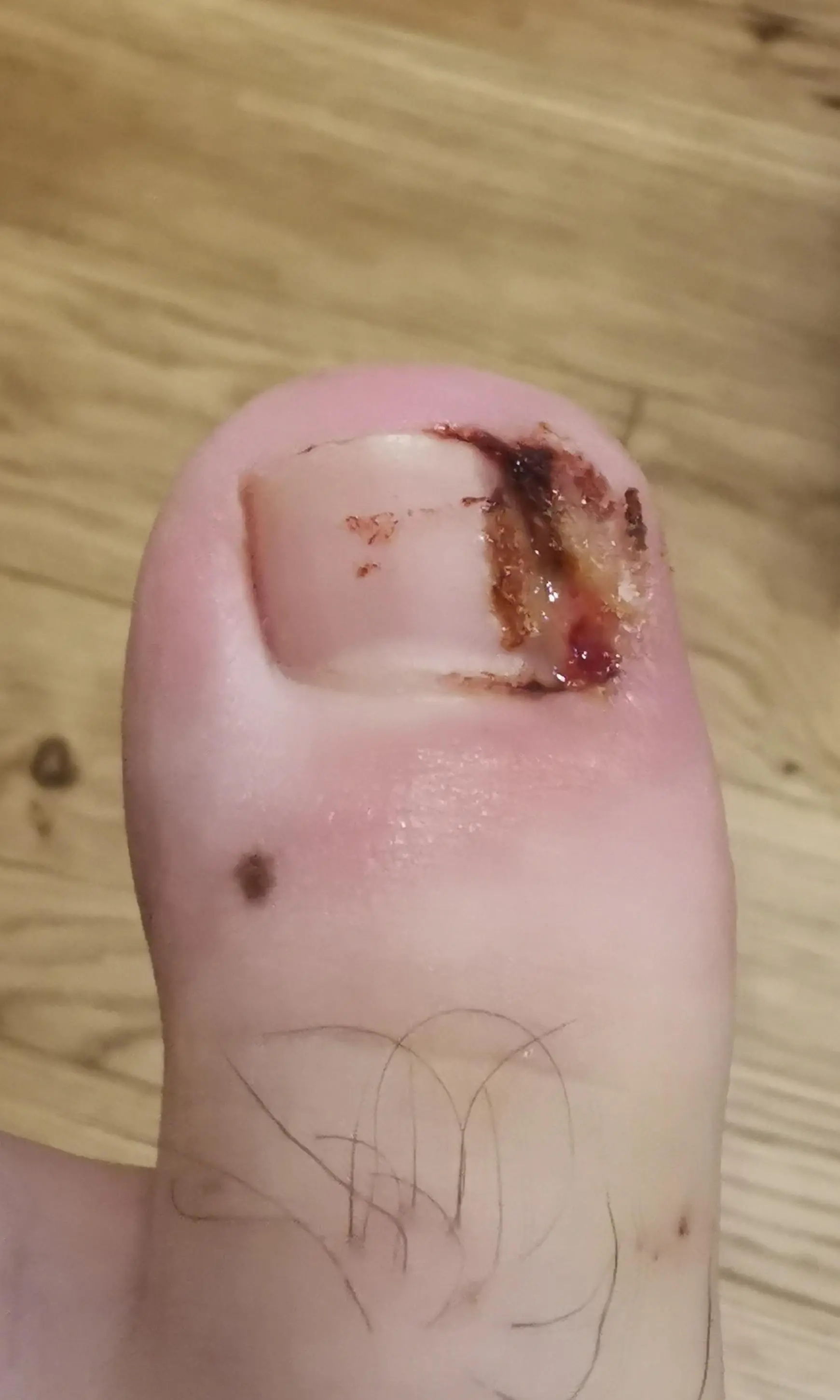 To give thanks to those who wished me well on my recovery, and to give in to the "SHOW THE TOE" demands, I give you my toe just after taking the bandage off this evening