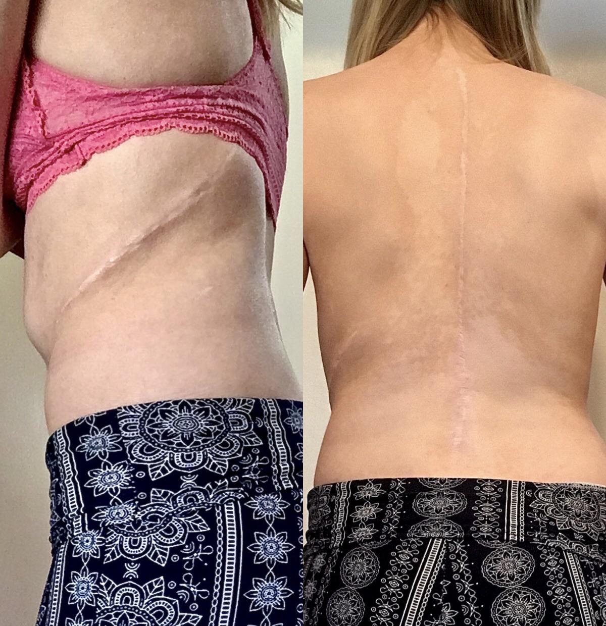 Update on my scars/back | Scrolller