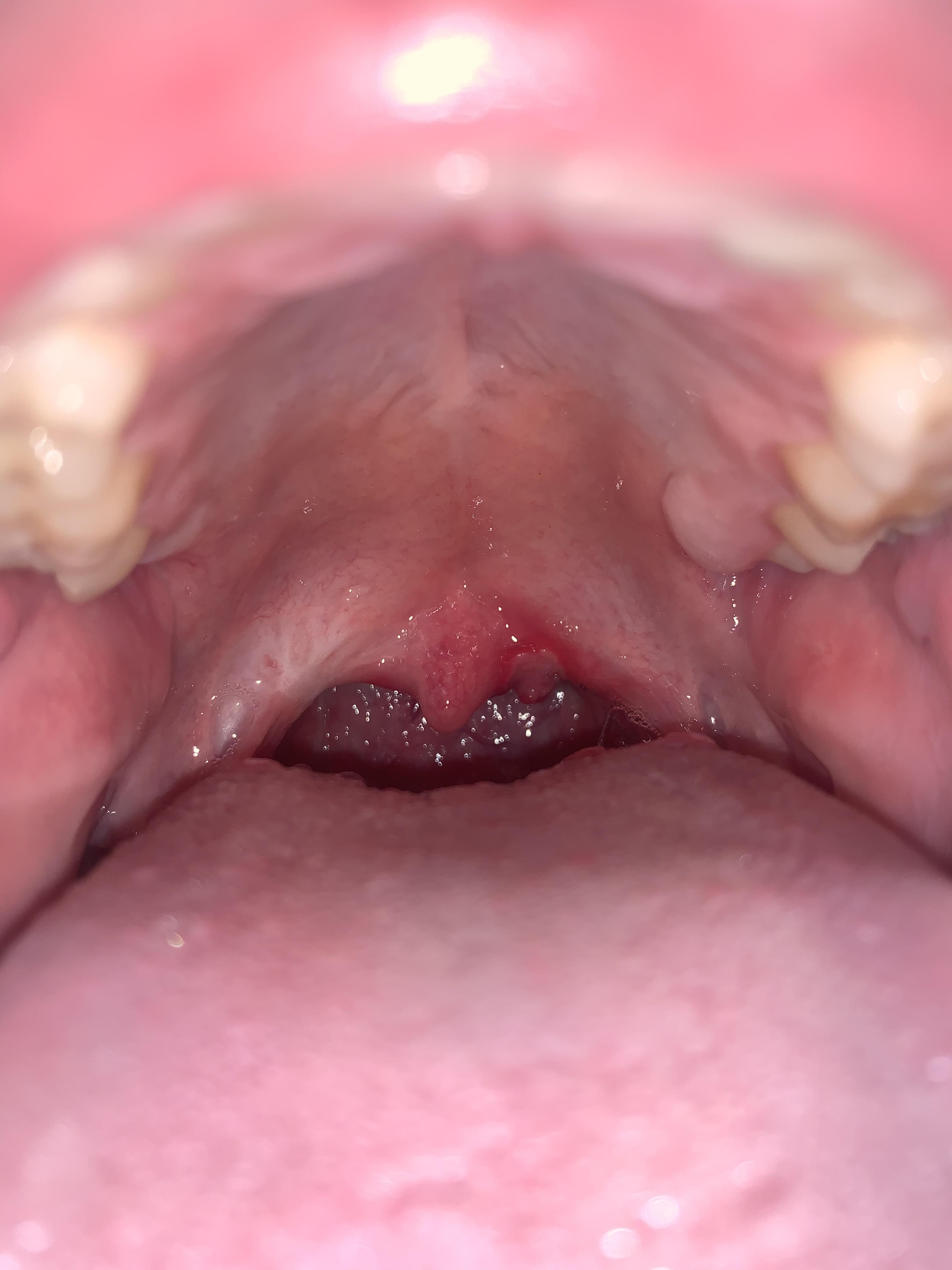 Weird Spot In My Throat Hurts When I Swallow Can Anyone Please Tell sore-throat-and-painful-swallowing-case-report-youtube