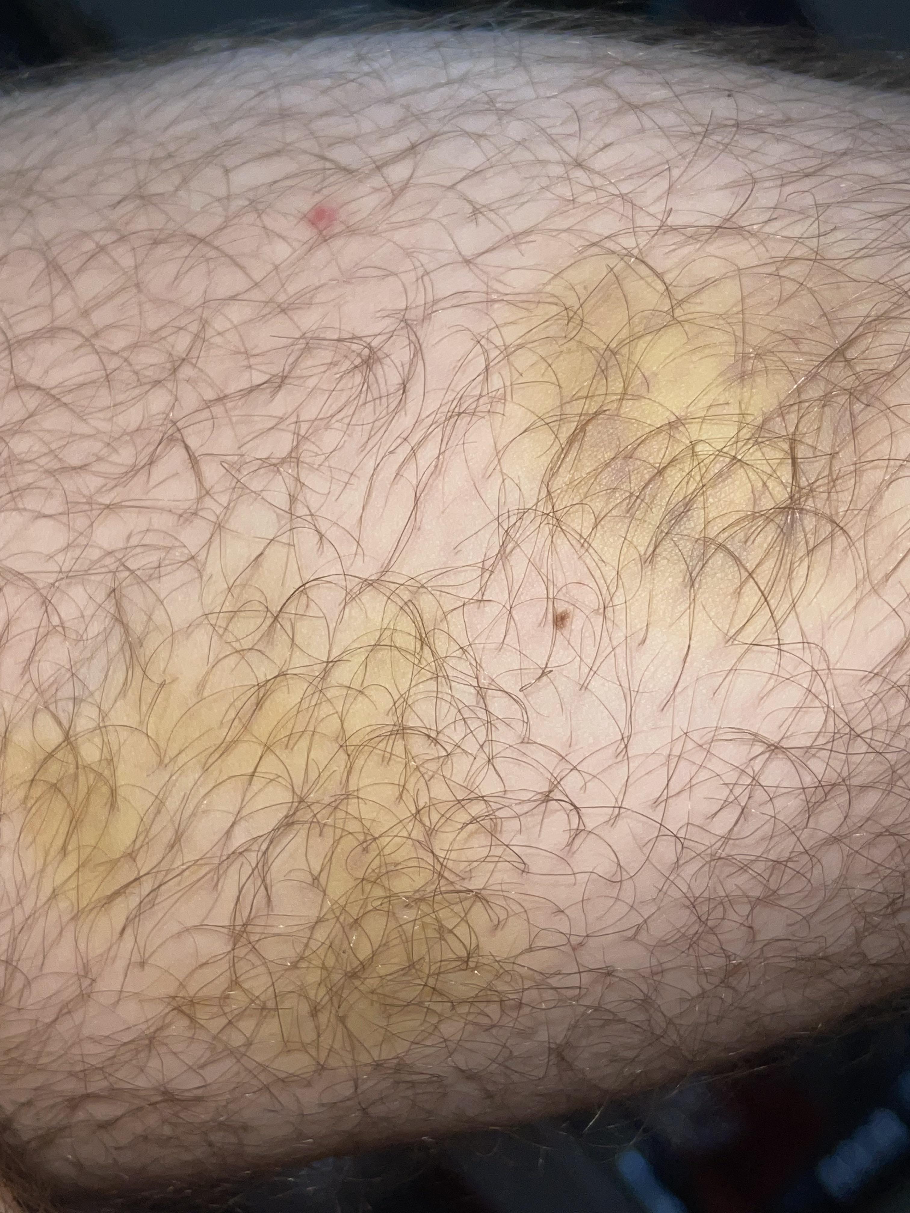 Yellow spots on my skin since my sarm cycle. Is this serious? | Scrolller