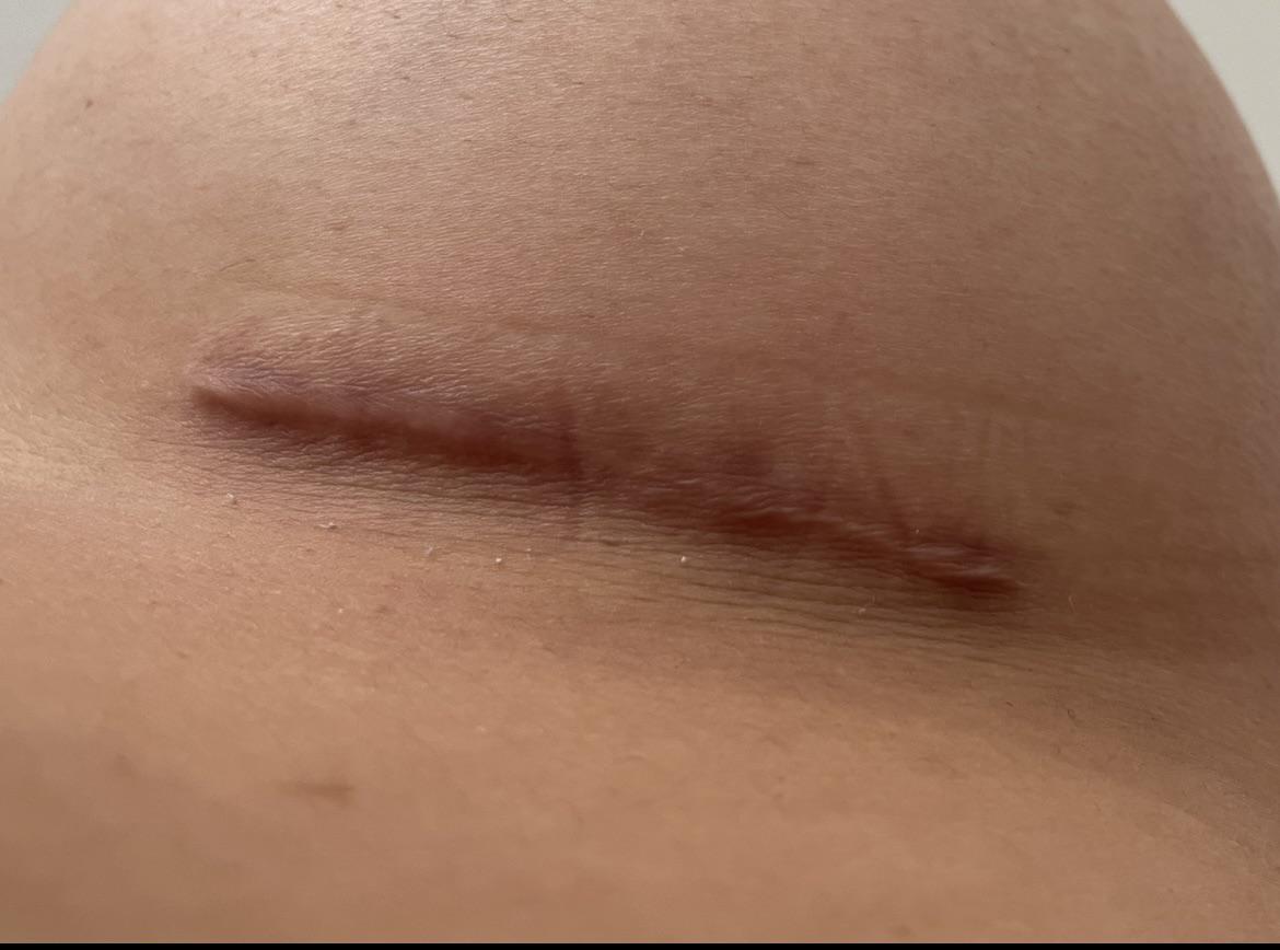 Augmentation Scae 11 months post op breast augmentation scar. Is this hypertropic ...