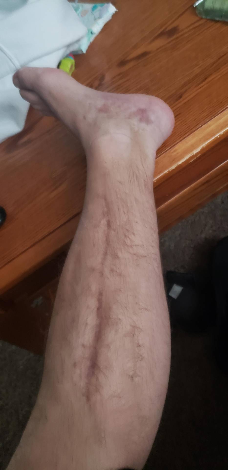 7 mo post fasciotomy