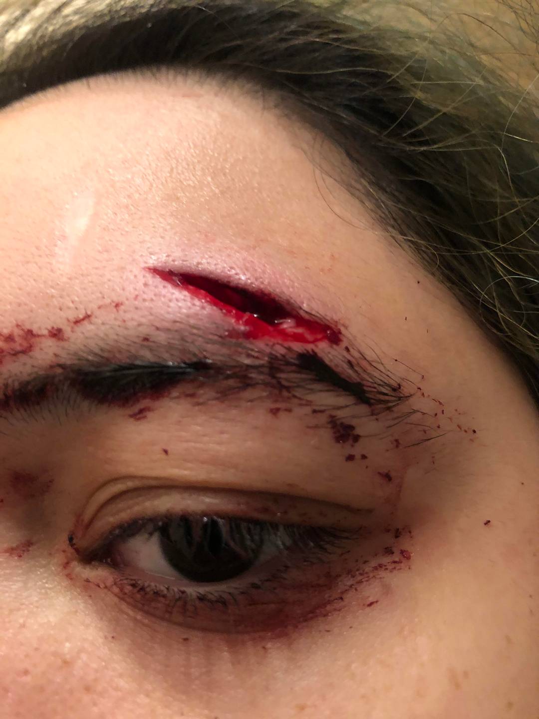 A nice addition to my forehead