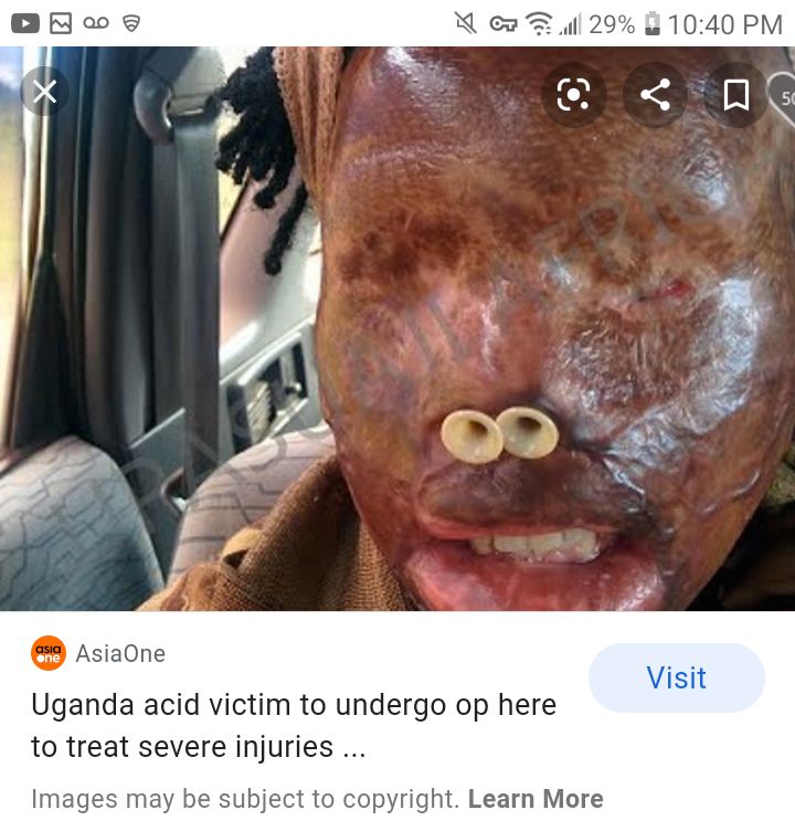 Acid attack survivor