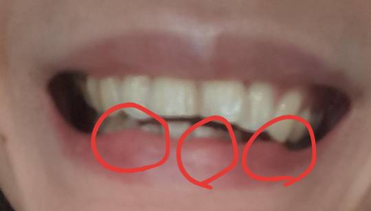 Botched bumpy lip from botched chin/jaw surgery with Bart Van de Ven.