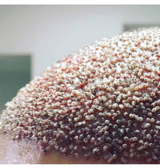 Infected hair follicles after hair transplant