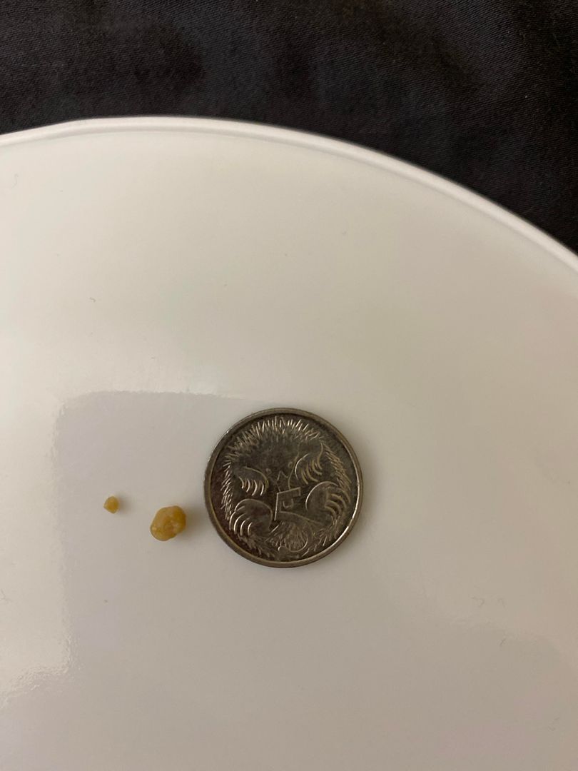 First ever tonsil stone... So gross! Also 5c piece for size lol