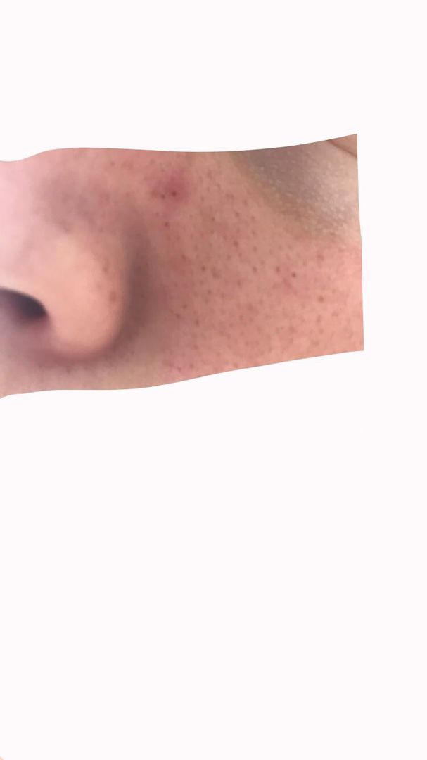 Help removing these blackheads on cheek. They are very large and also occur on my forehead and chin but they are less noticeable