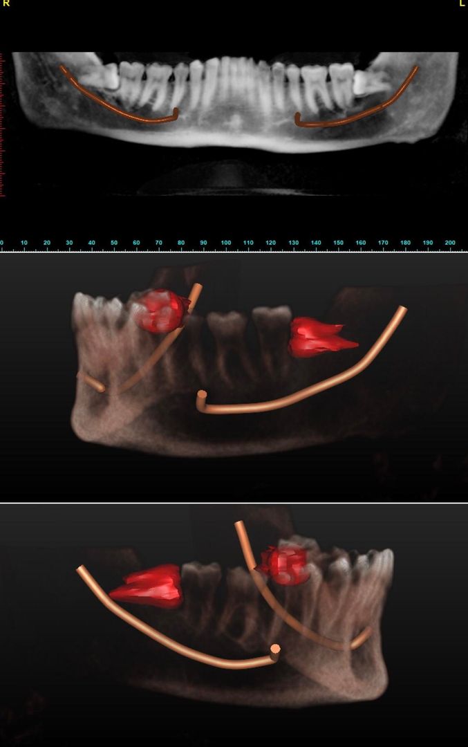 here’s my 3D Cone Beam Scan. those wisdom teeth were sitting completely sideways
