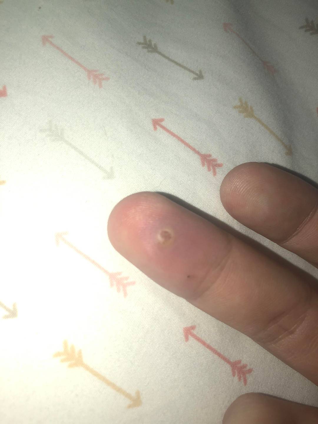 I accidentally punctured my finger with a staple gun 6days ago and now it’s getting filled with fluid, so i drained out a little bit of fluid with a lancet device, I don’t see getting improved btw... do y’all think i have to go see a doc? Does anyone have similar experience?